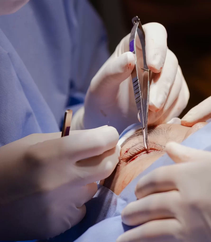blefaroplastia após 7 dias