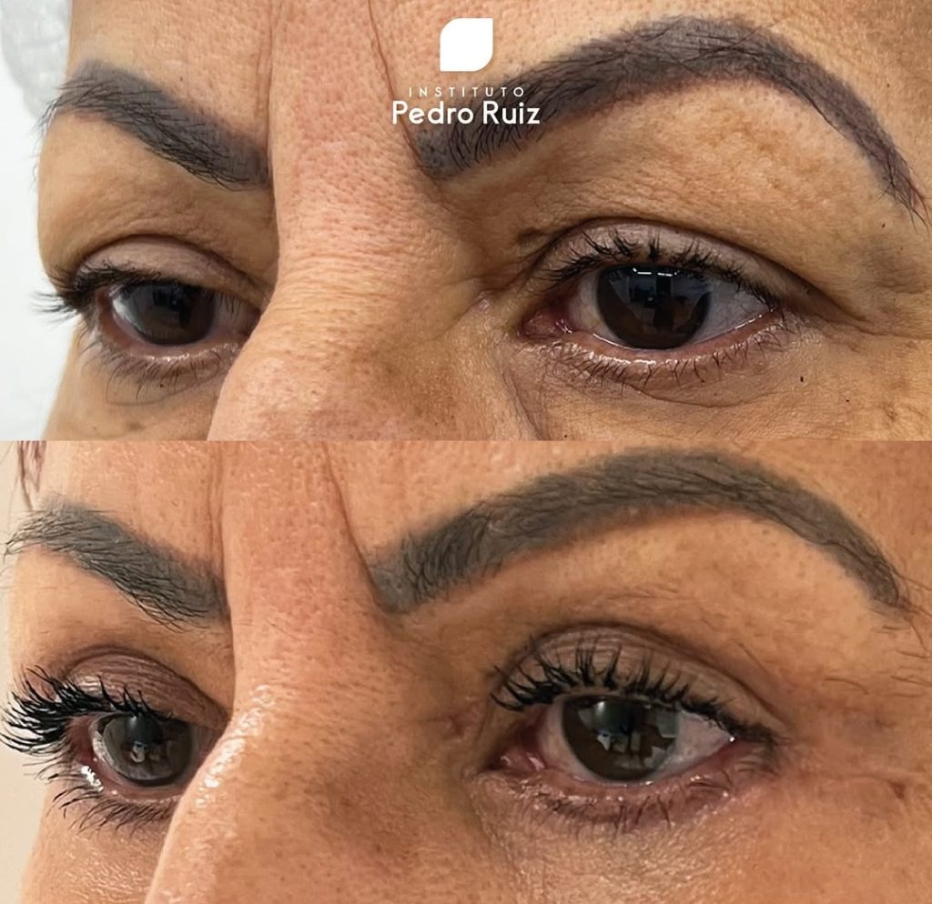 Quando a blefaroplastia passa a ser funcional