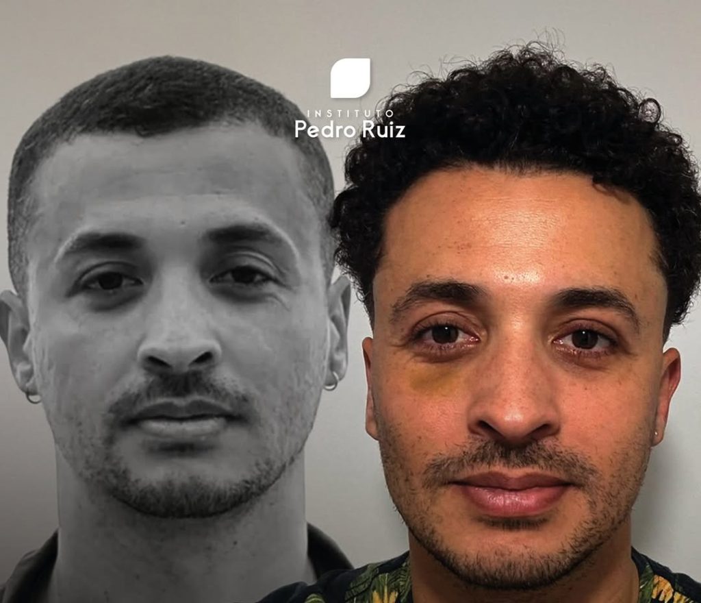 impacto da blefaroplastia