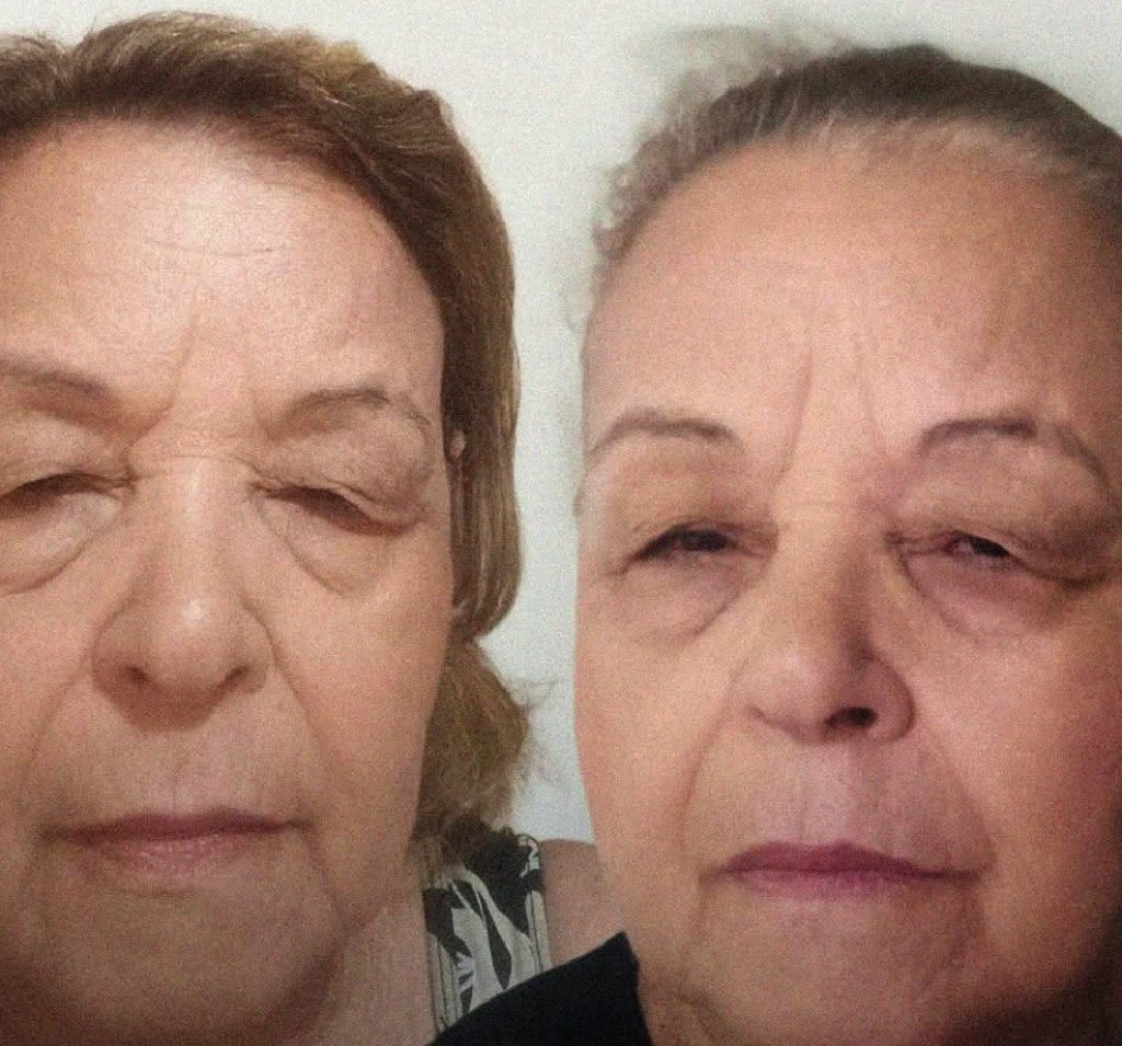 vida-de-quem-faz-blefaroplastia