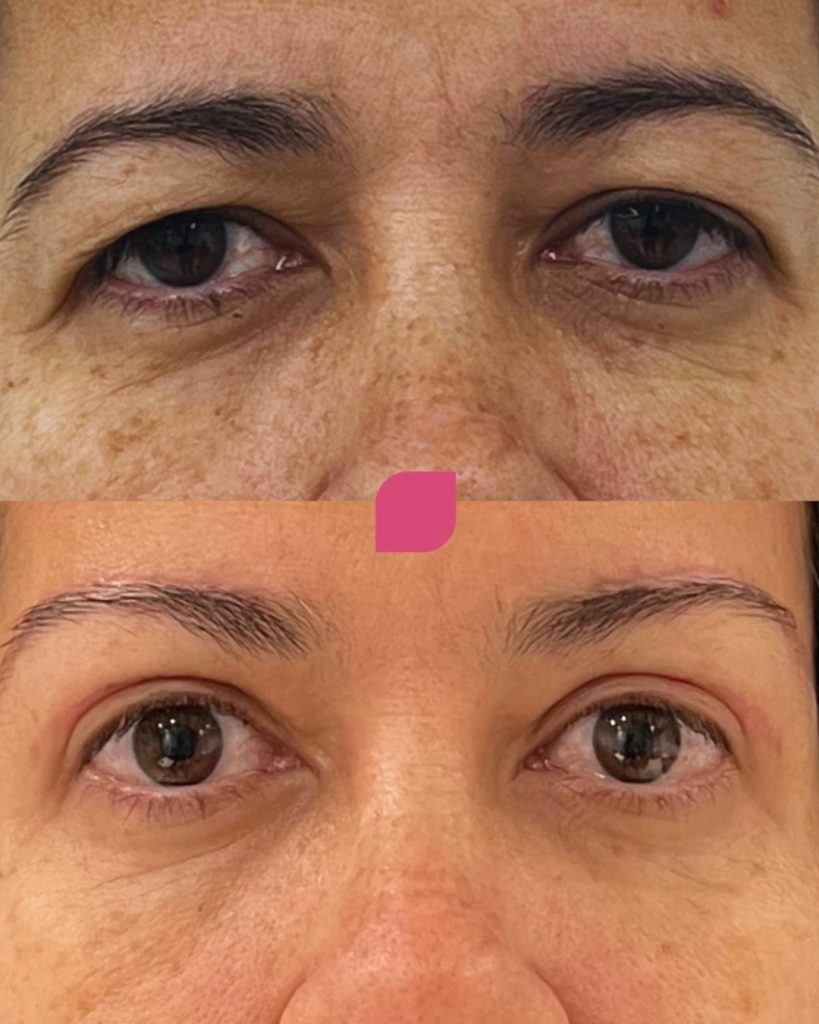 blefaroplastia inferior 4