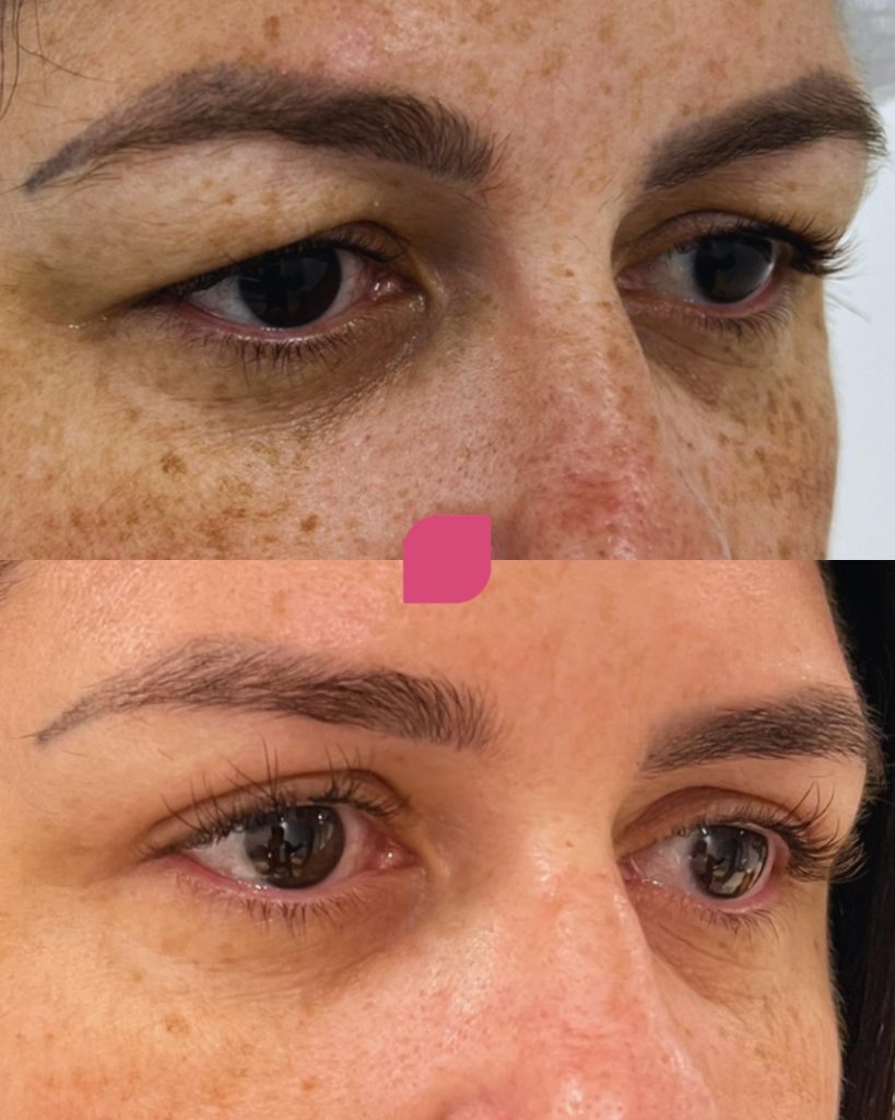blefaroplastia superior 1