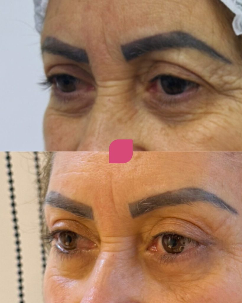 blefaroplastia superior 3