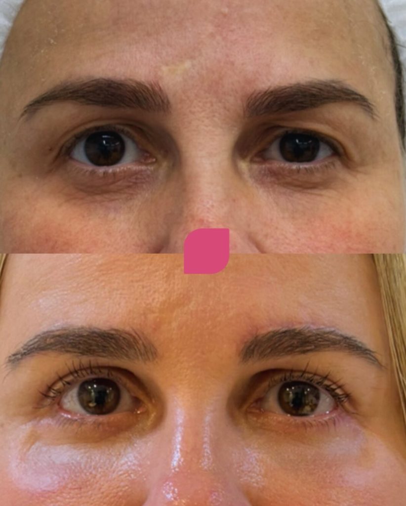 Blefaroplastia Instituto Pedro Ruiz