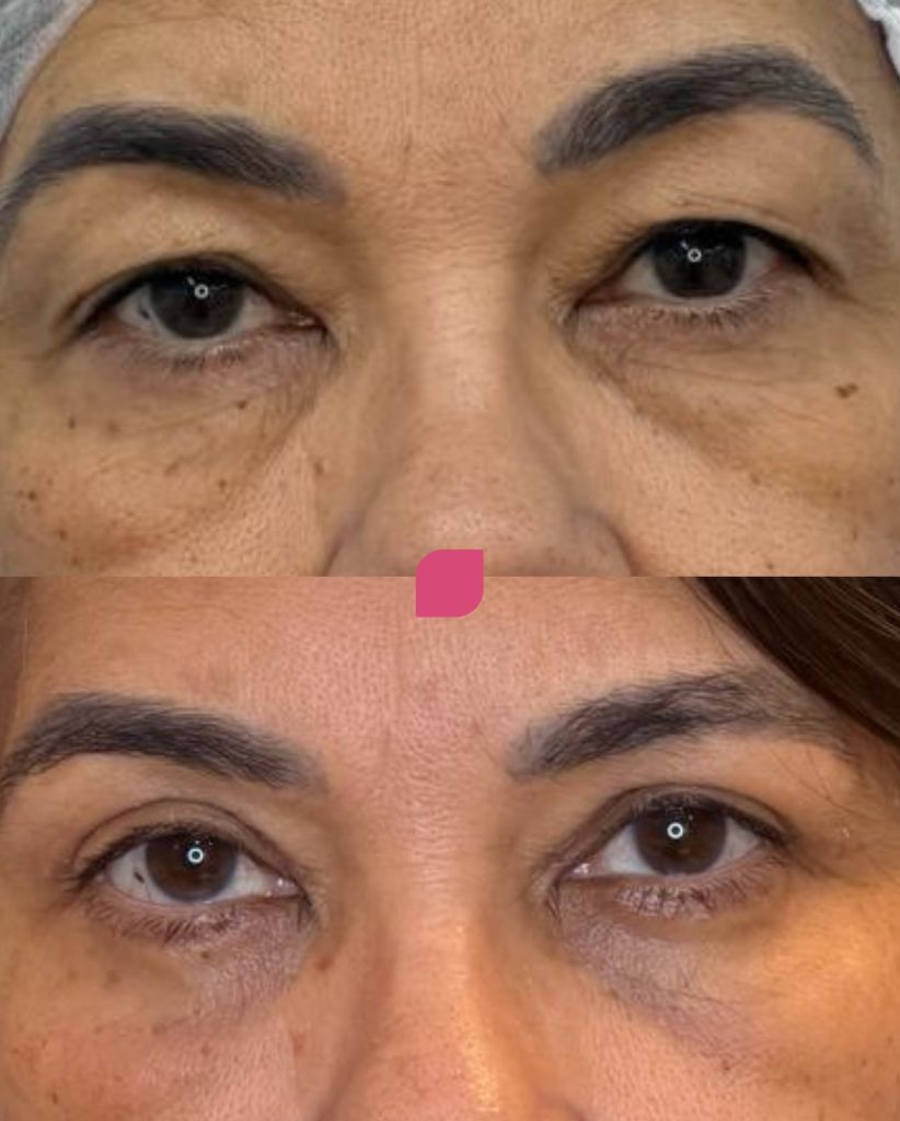 Blefaroplastia antes e depois em mulheres_resultados reais