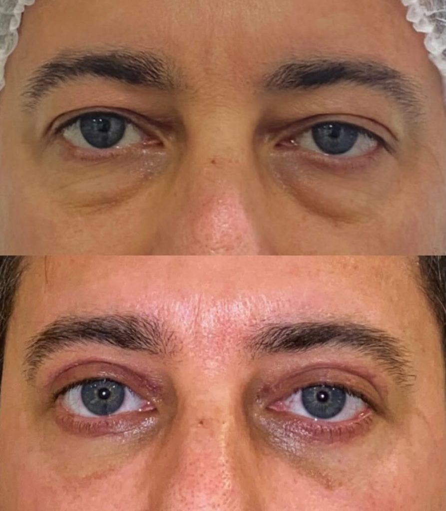 blefaroplastia em homem antes e depois