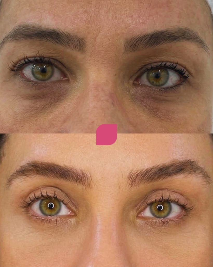 blefaroplastia preparação e antes e depois