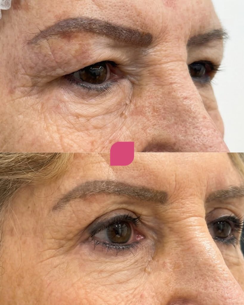 cicatrização da blefaroplastia
