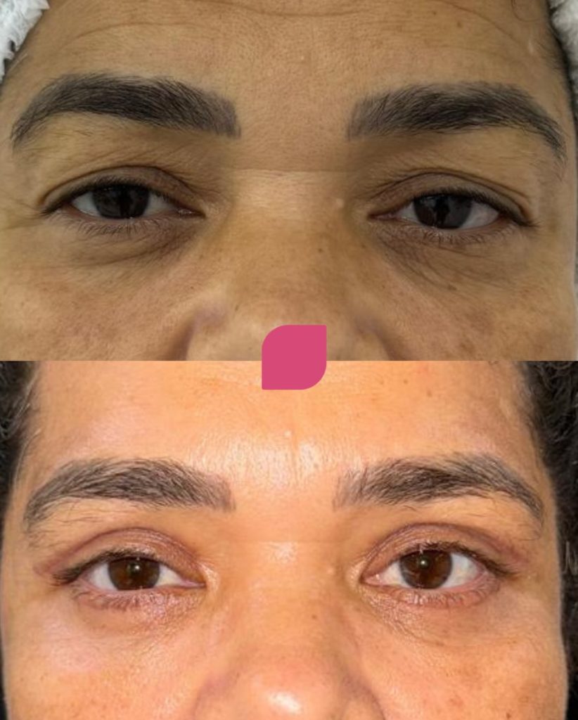 pálpebra caída blefaroplastia 2