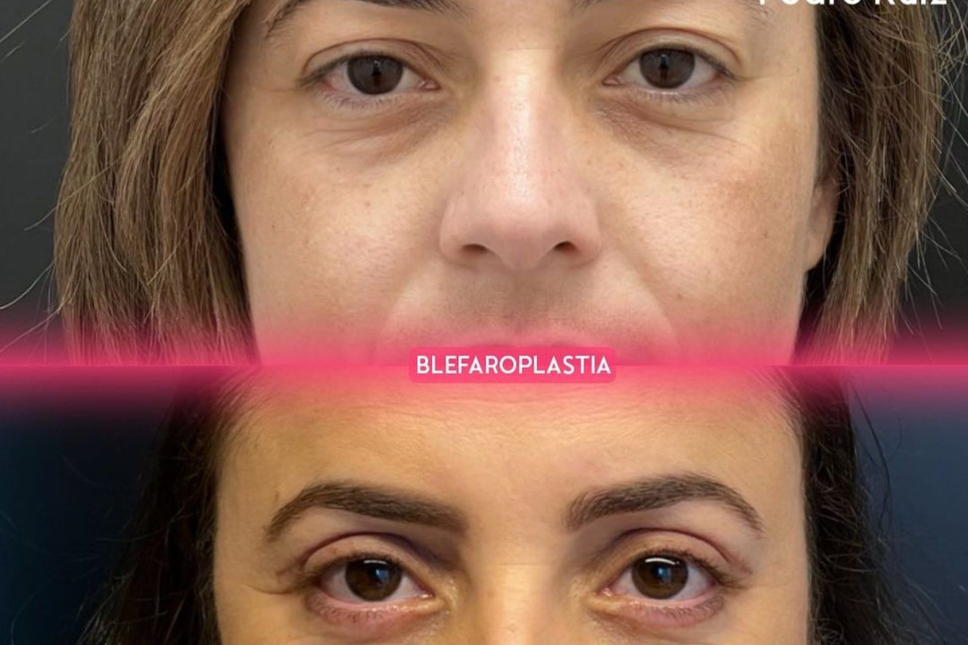 blefaroplastia-antes-e-depois