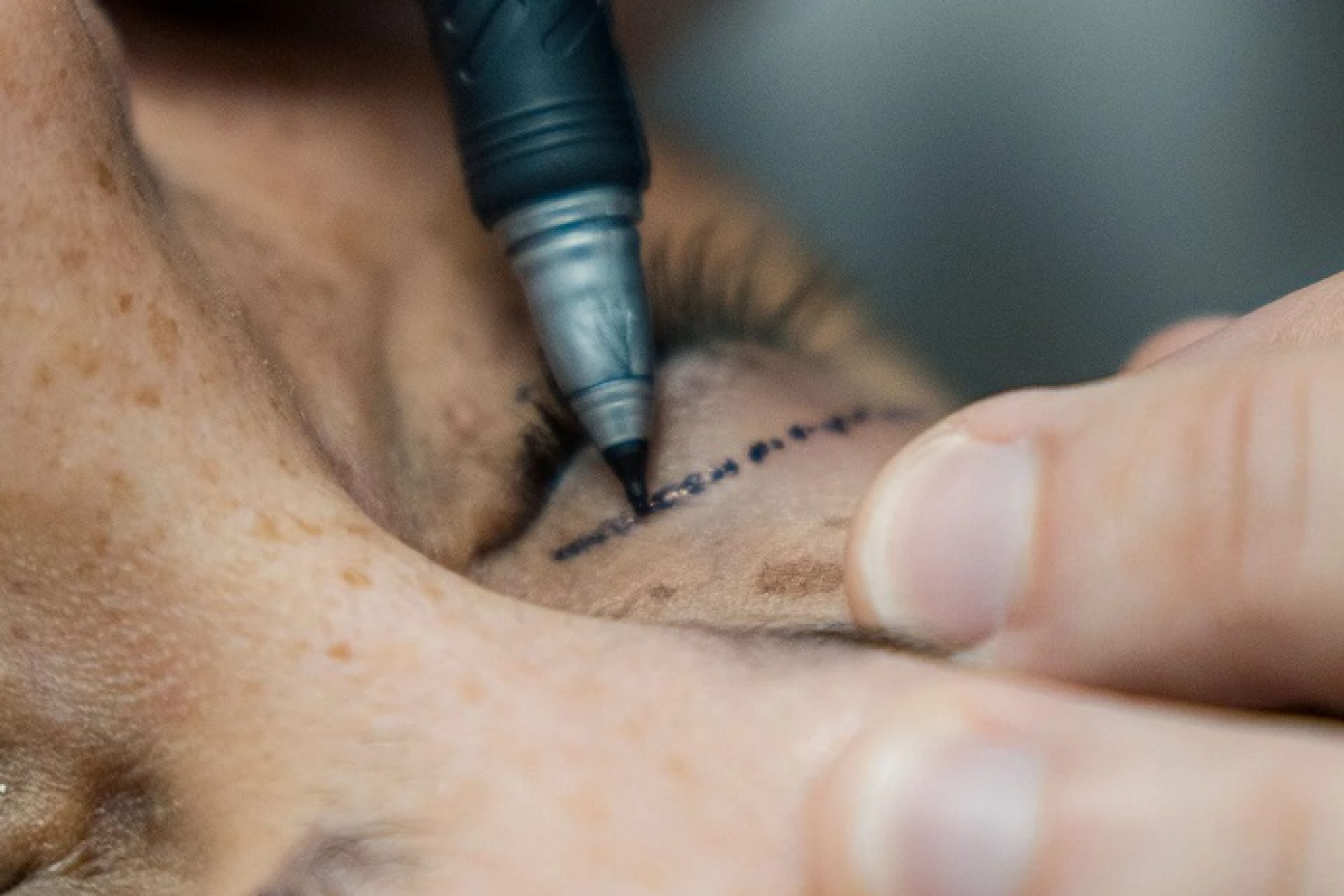 Blefaroplastia