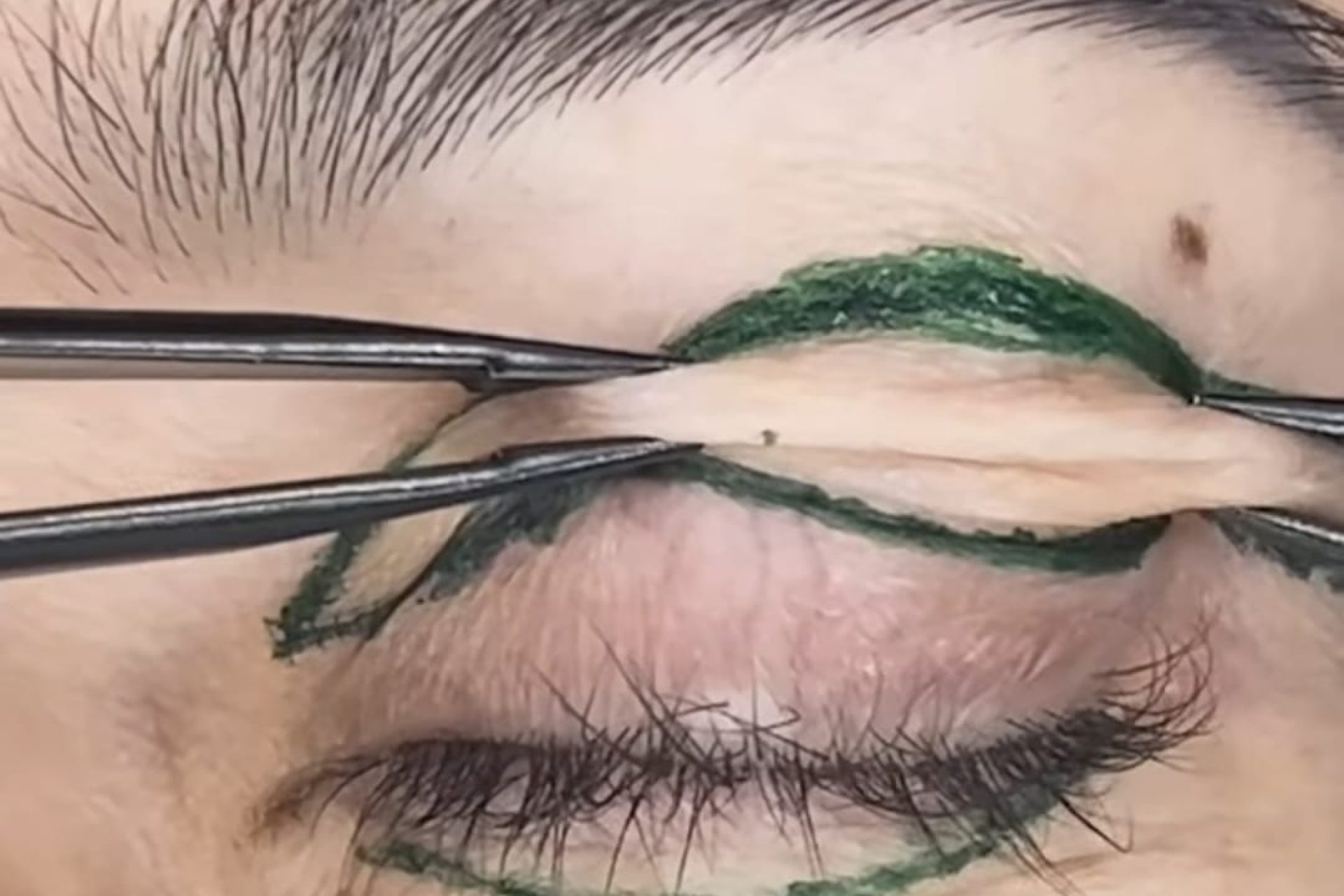 BLEFAROPLASTIA CIRÚRGICA