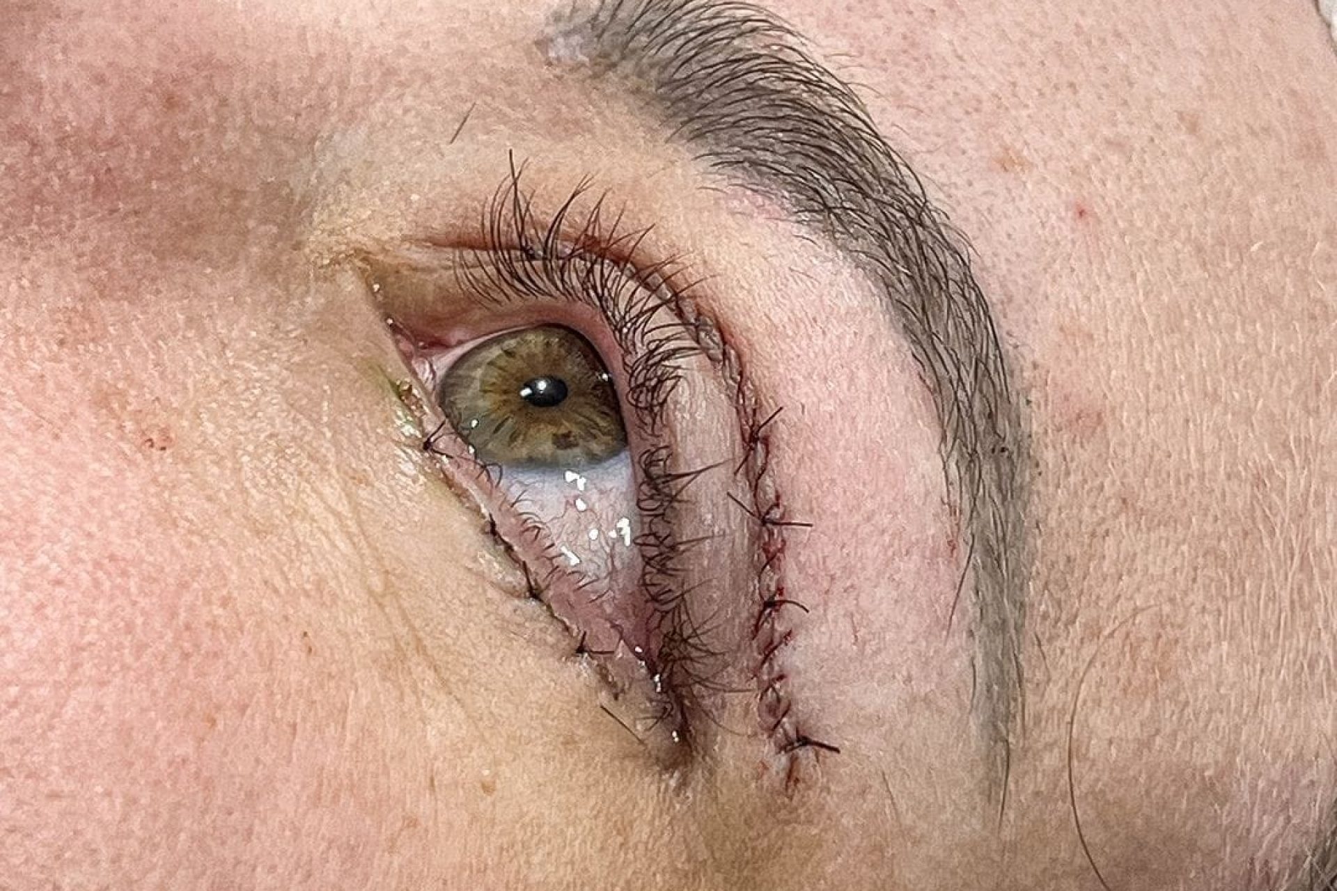 O que é blefaroplastia