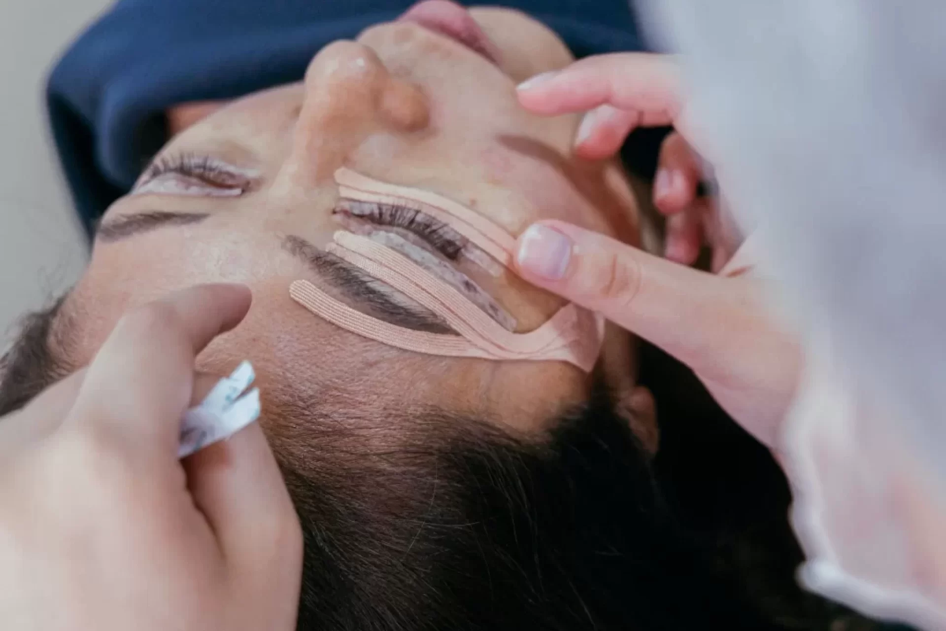 Blefaroplastia pálpebra caída
