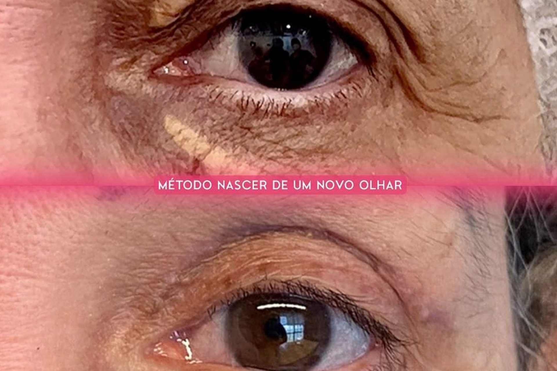 Blefaroplastia Pré-e Pós-Operatório