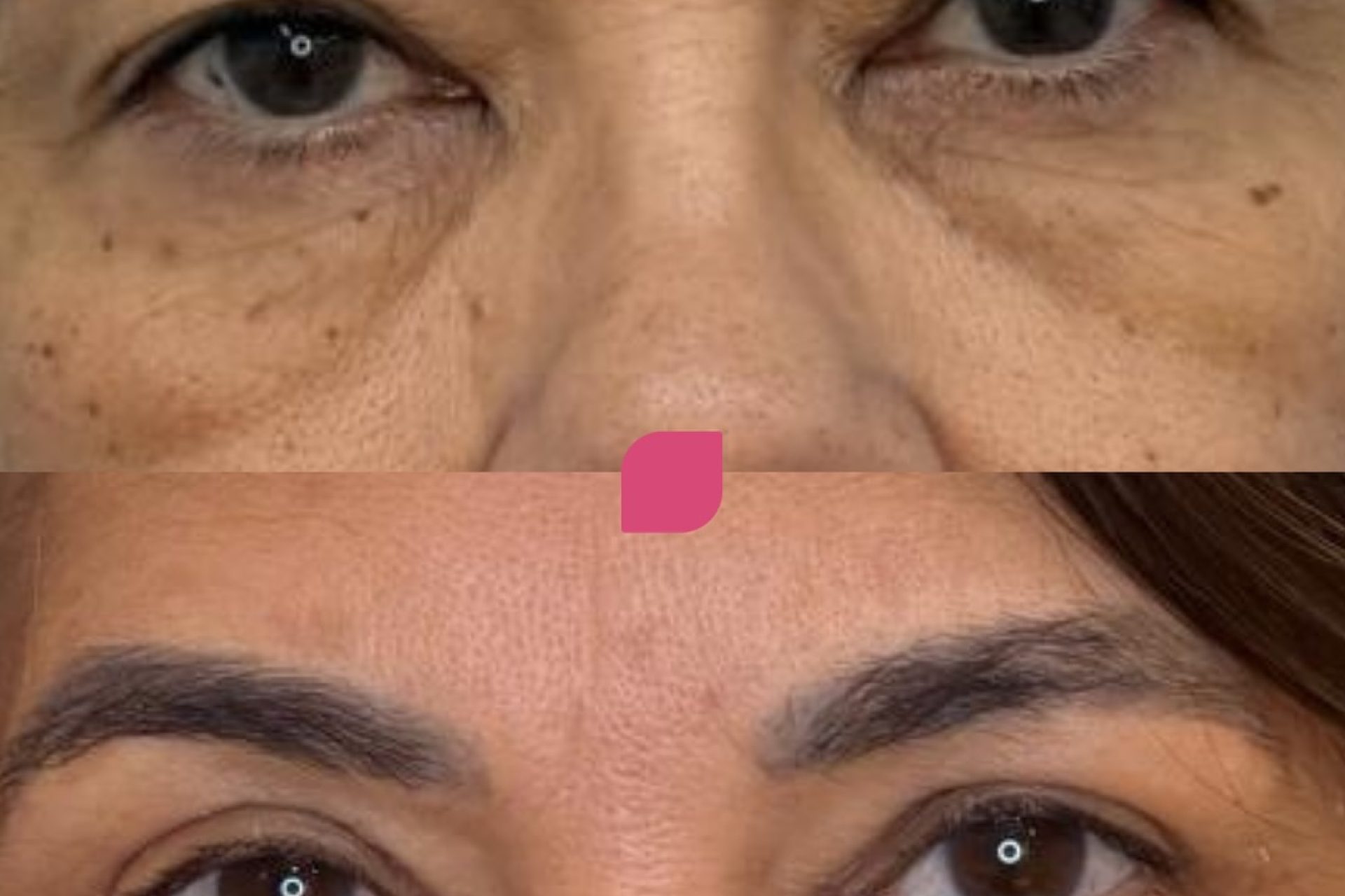 Blefaroplastia antes e depois em mulheres_resultados reais