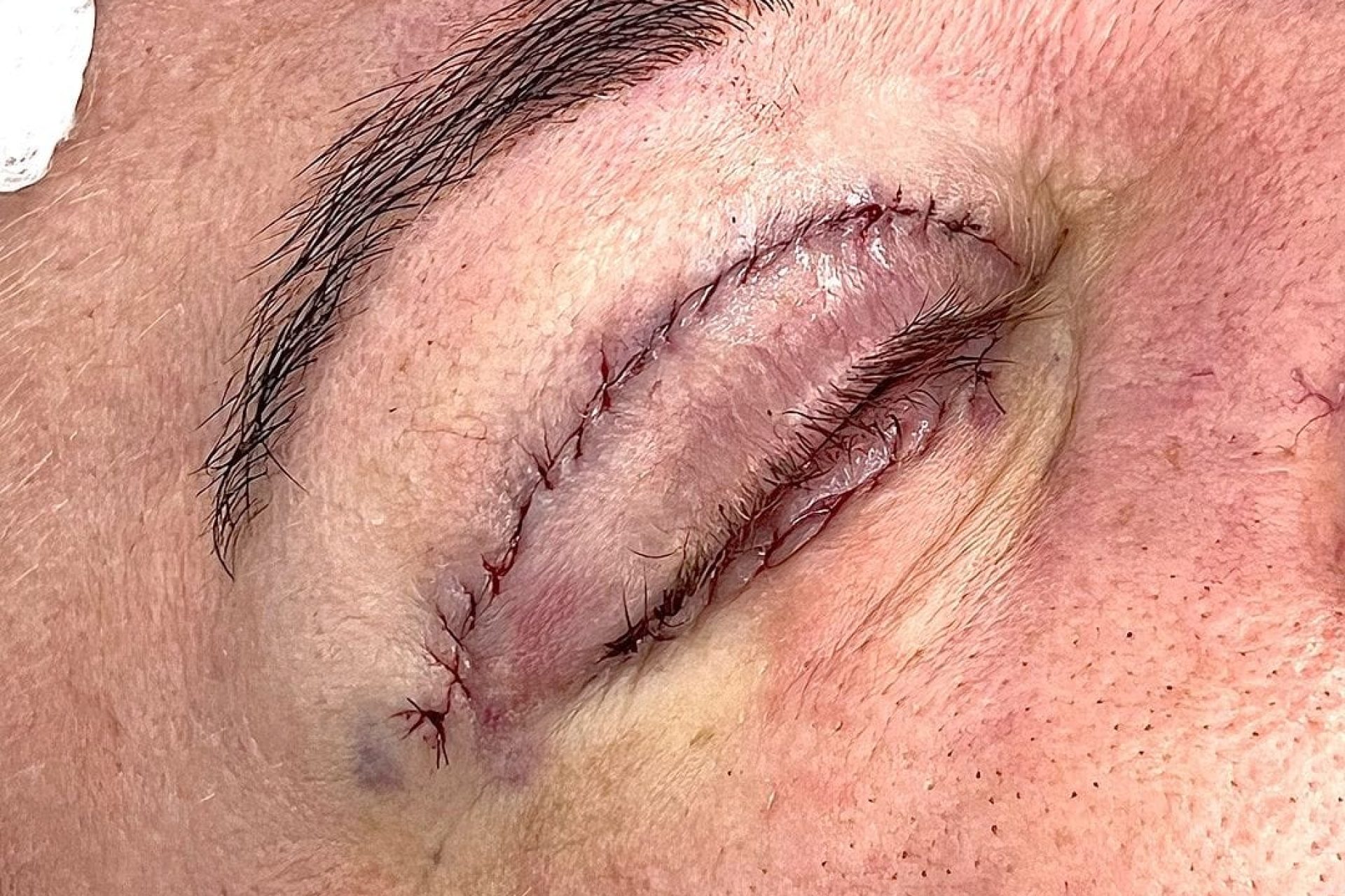 Blefaroplastia dói