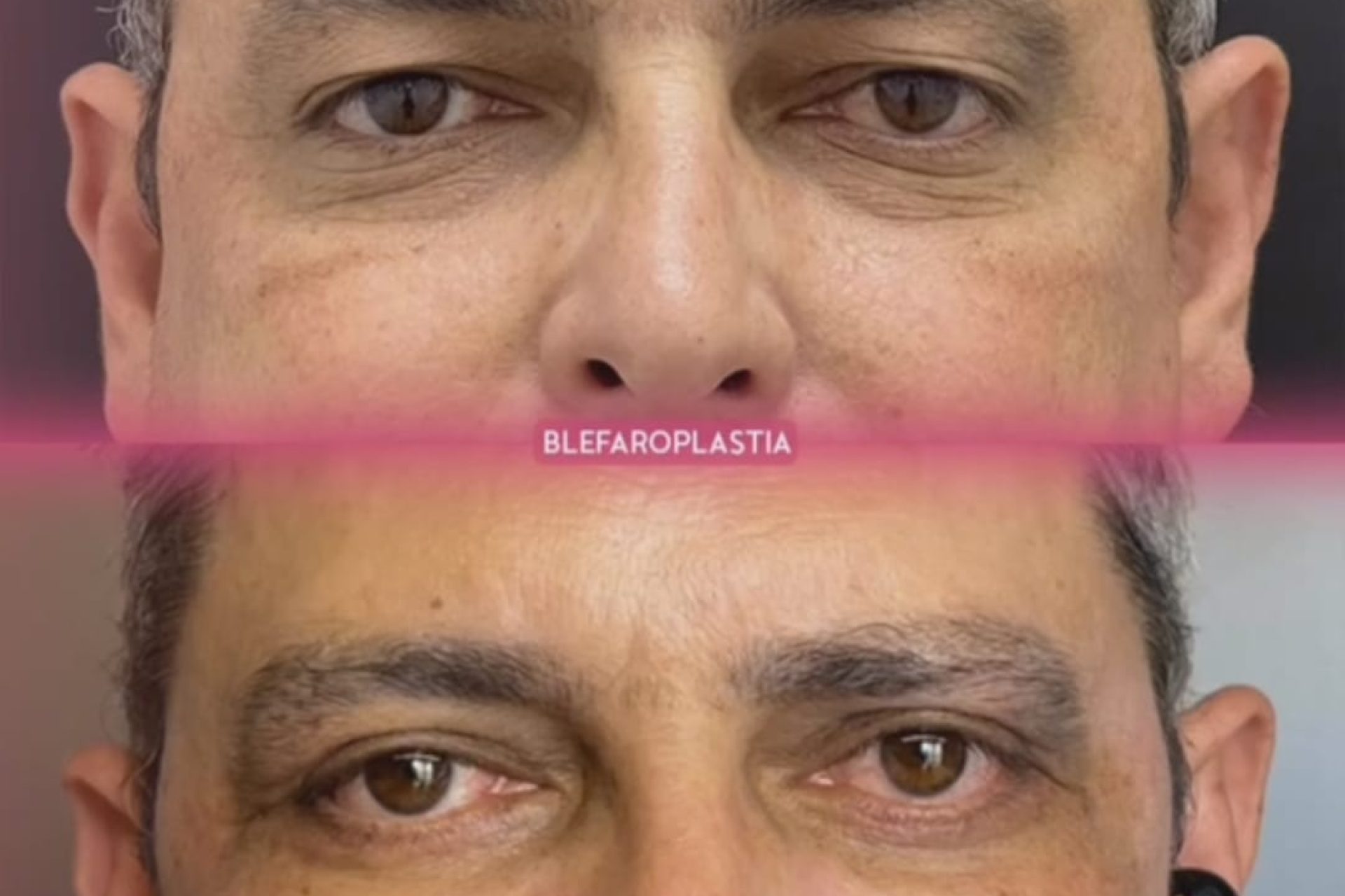 Blefaroplastia em homens