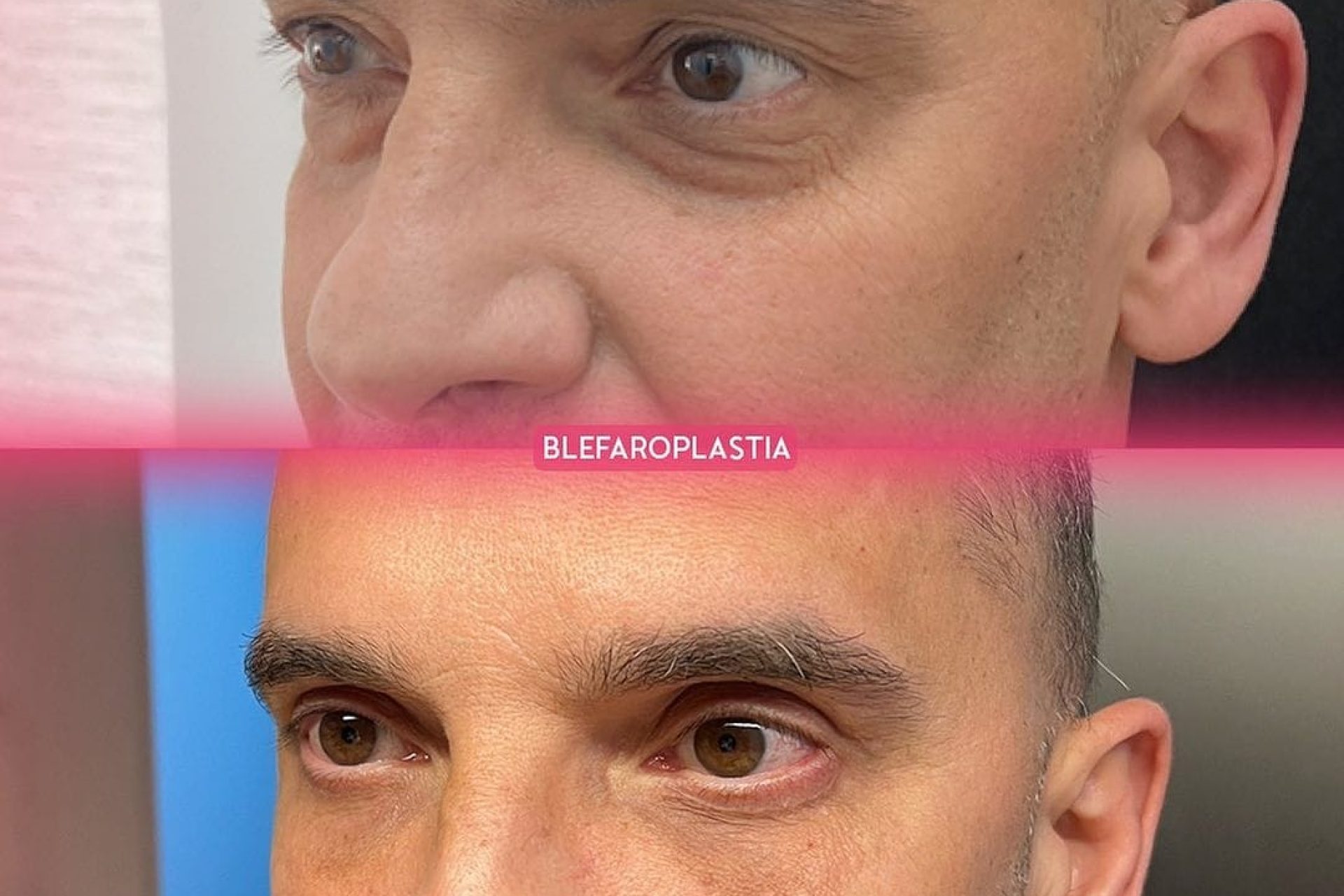 Blefaroplastia em homens