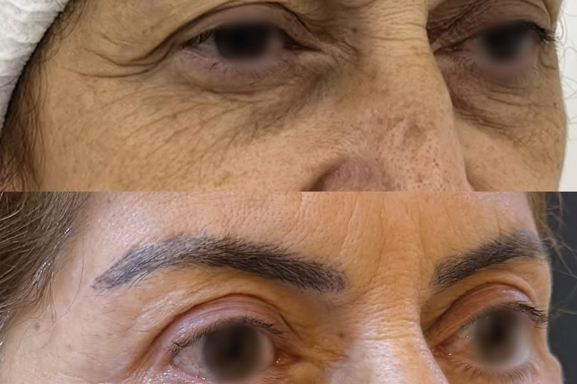 Blefaroplastia em mulheres e homens tem diferença-03