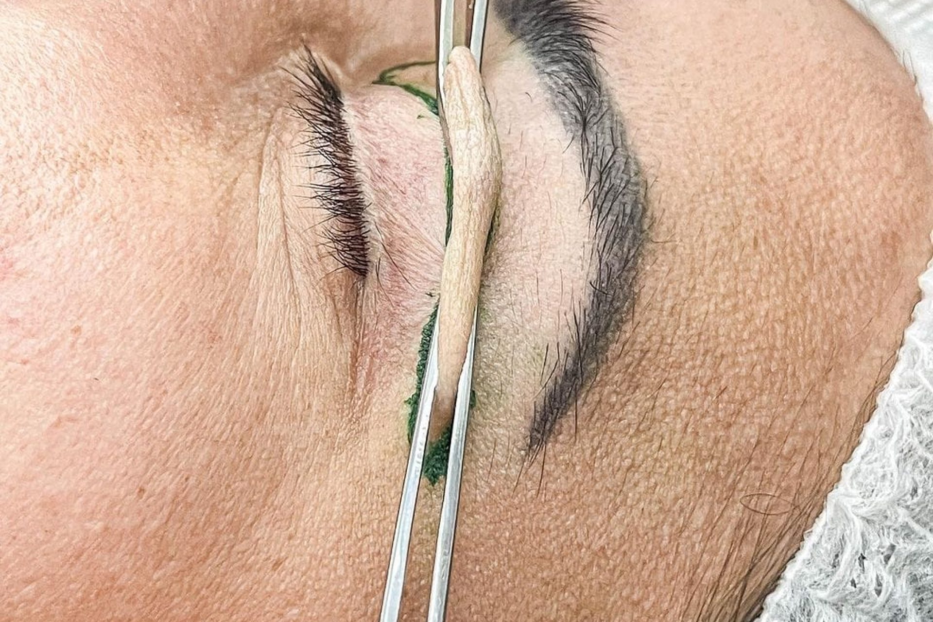 Blefaroplastia é indicada
