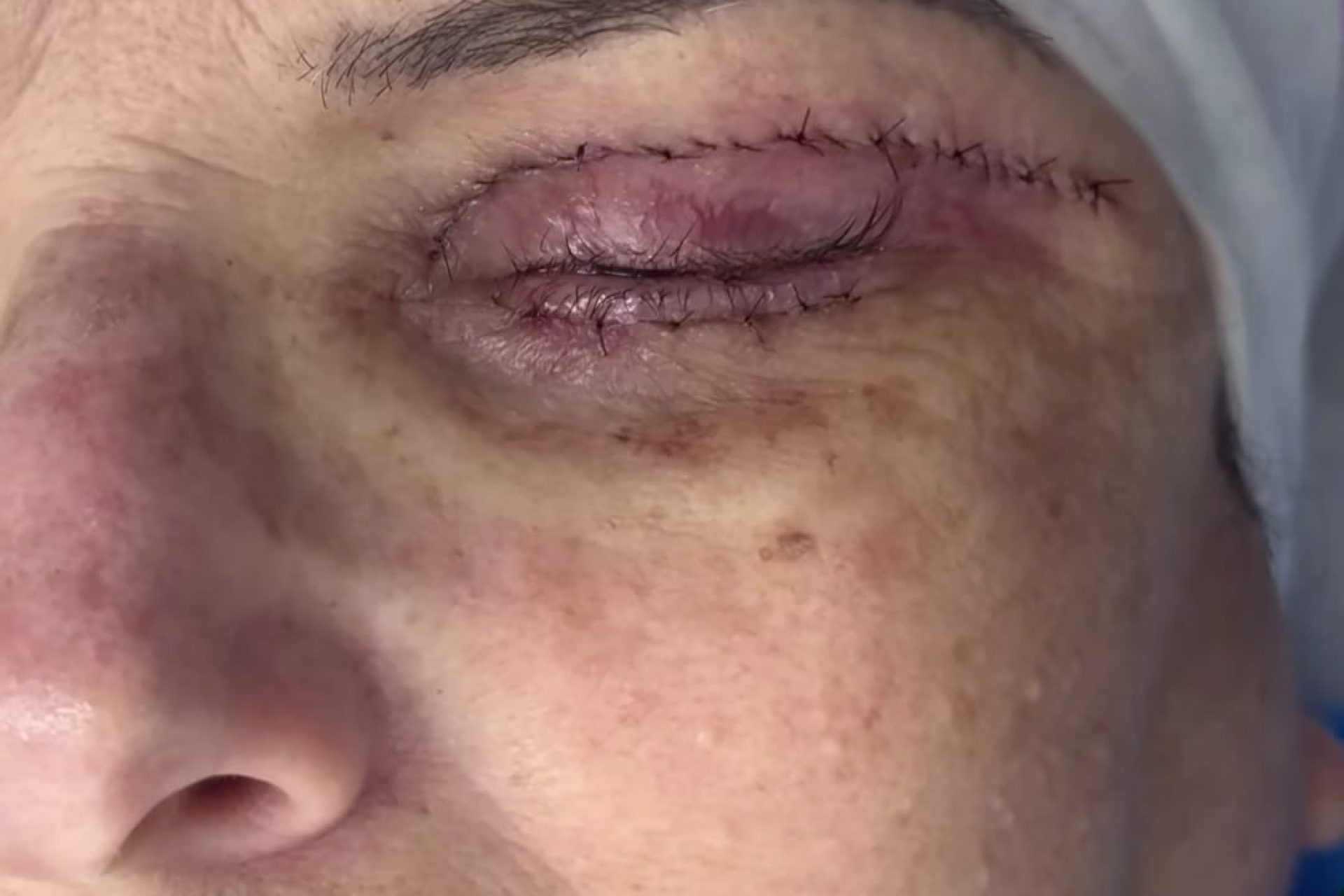 Pontos blefaroplastia