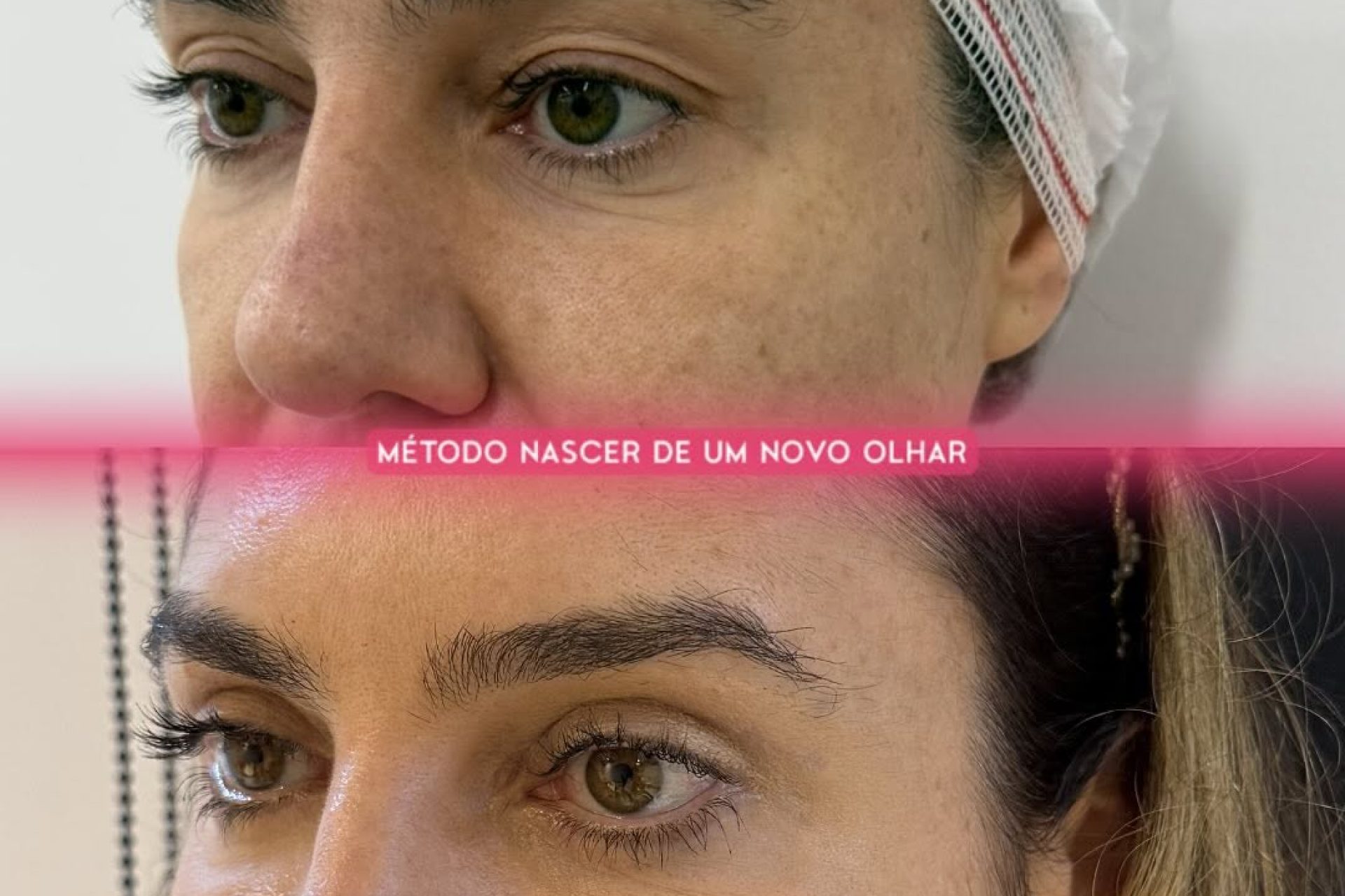 Blefaroplastia resultado antes e depois 2