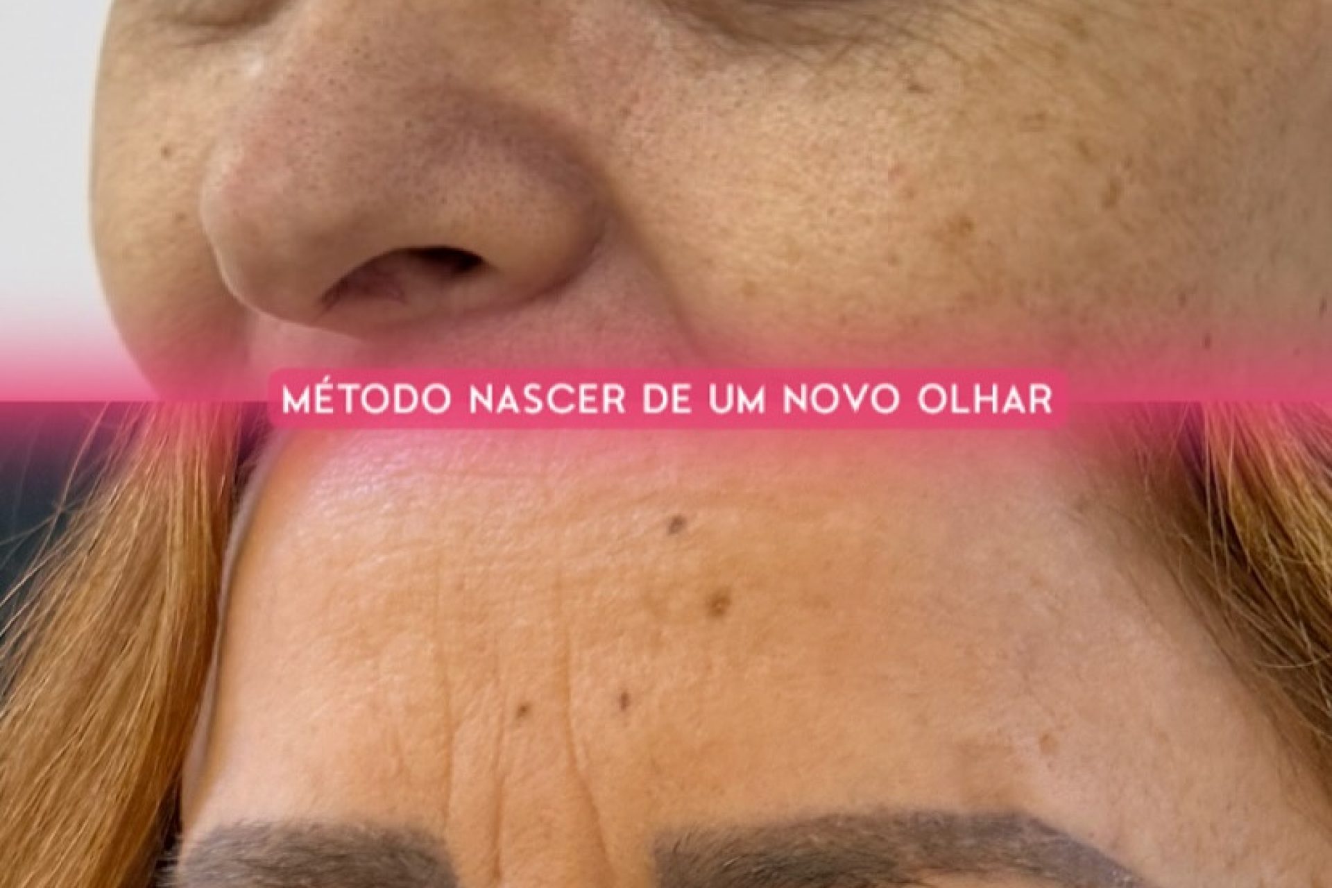 Blefaroplastia-resultado-antes-e-depois