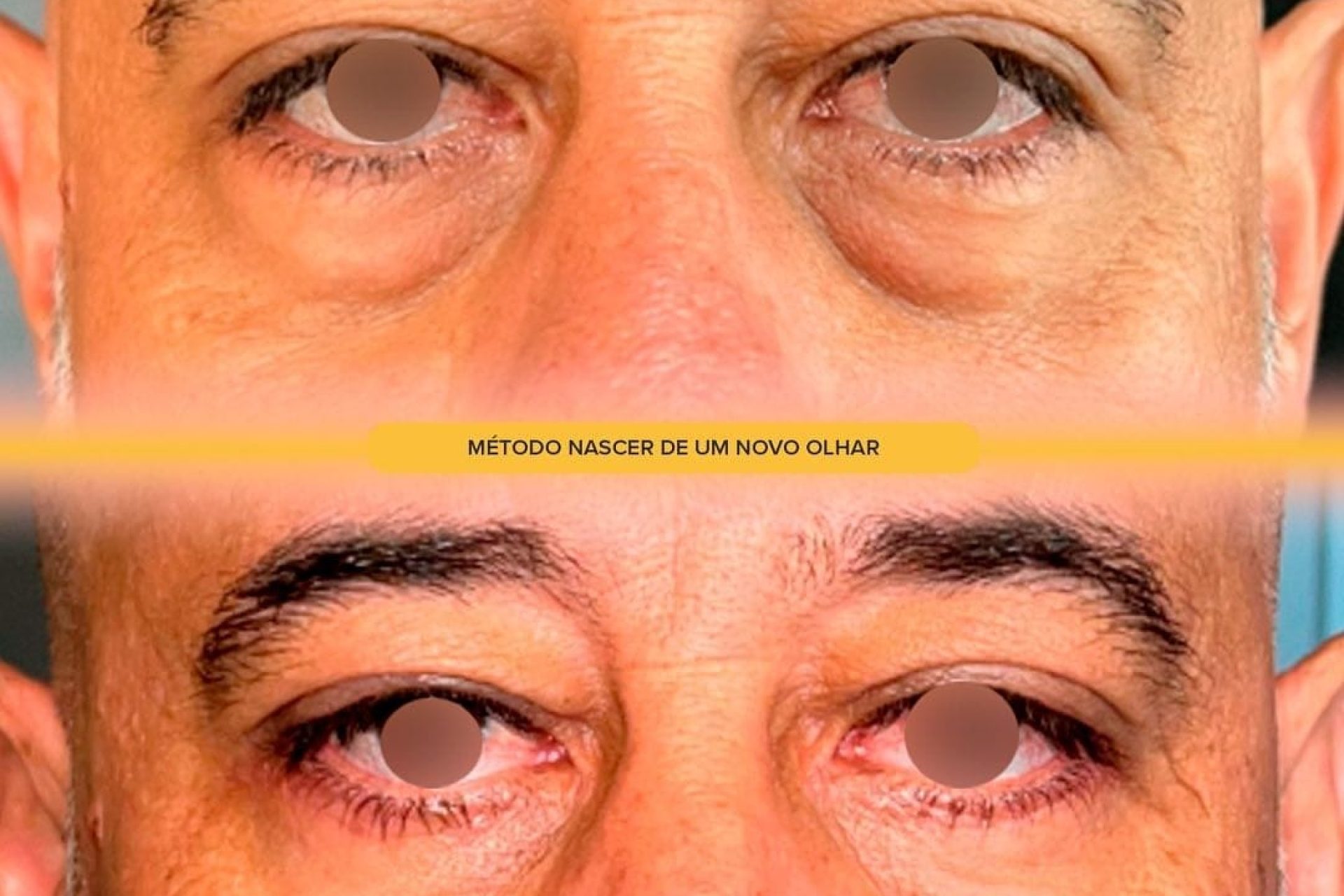 Blefaroplastia_resultado
