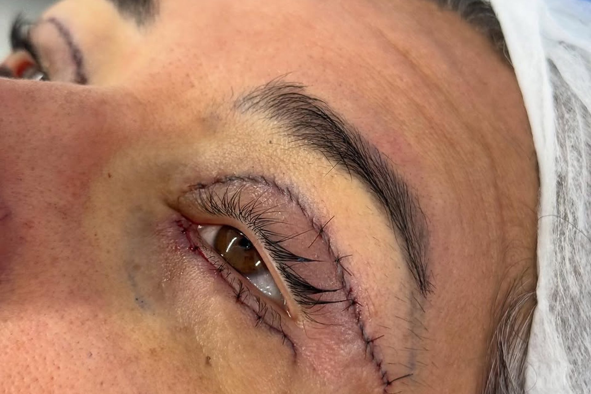 Cicatriz da blefaroplastia