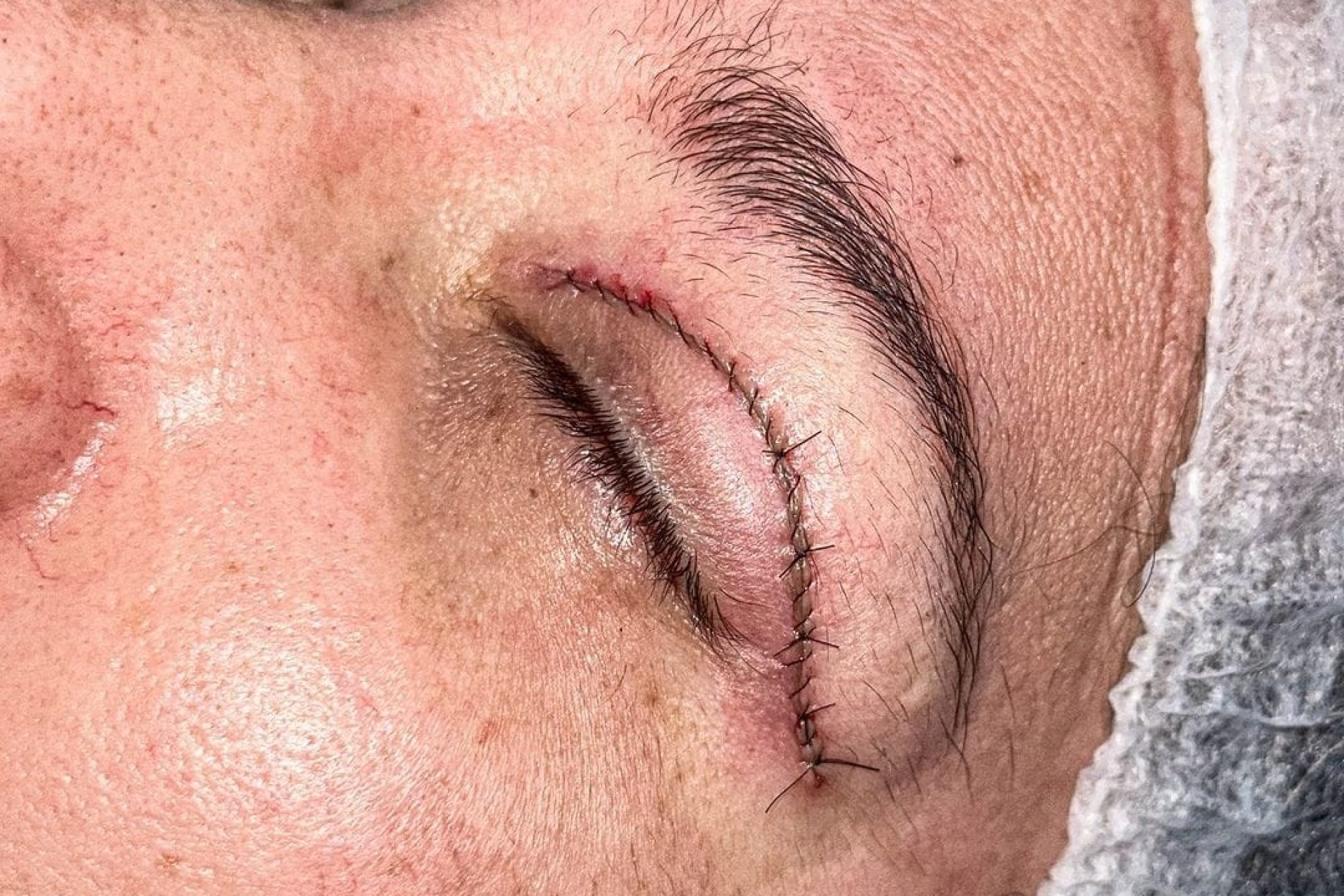 Cicatrização blefaroplastia