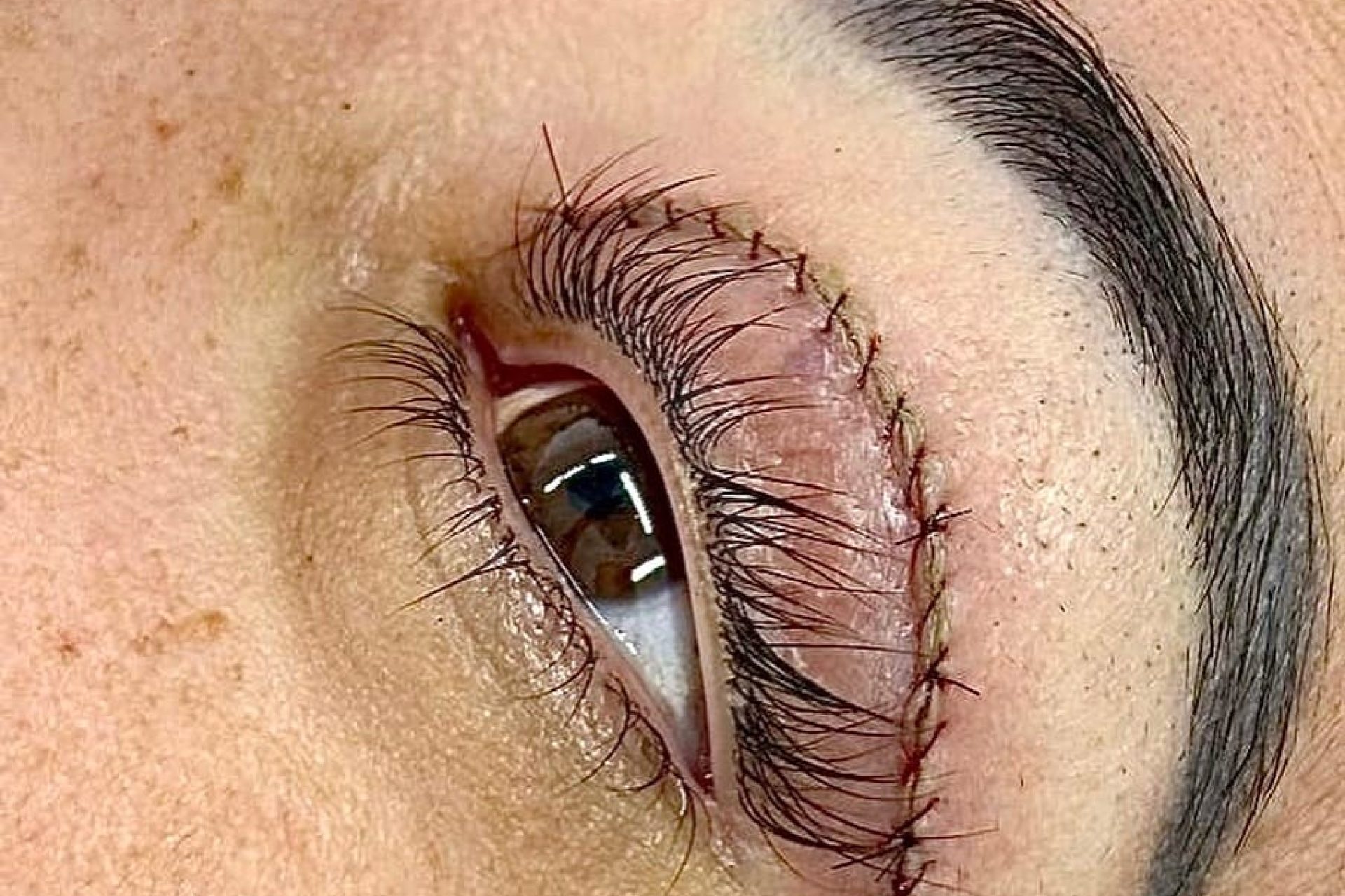 Cirurgia de blefaroplastia