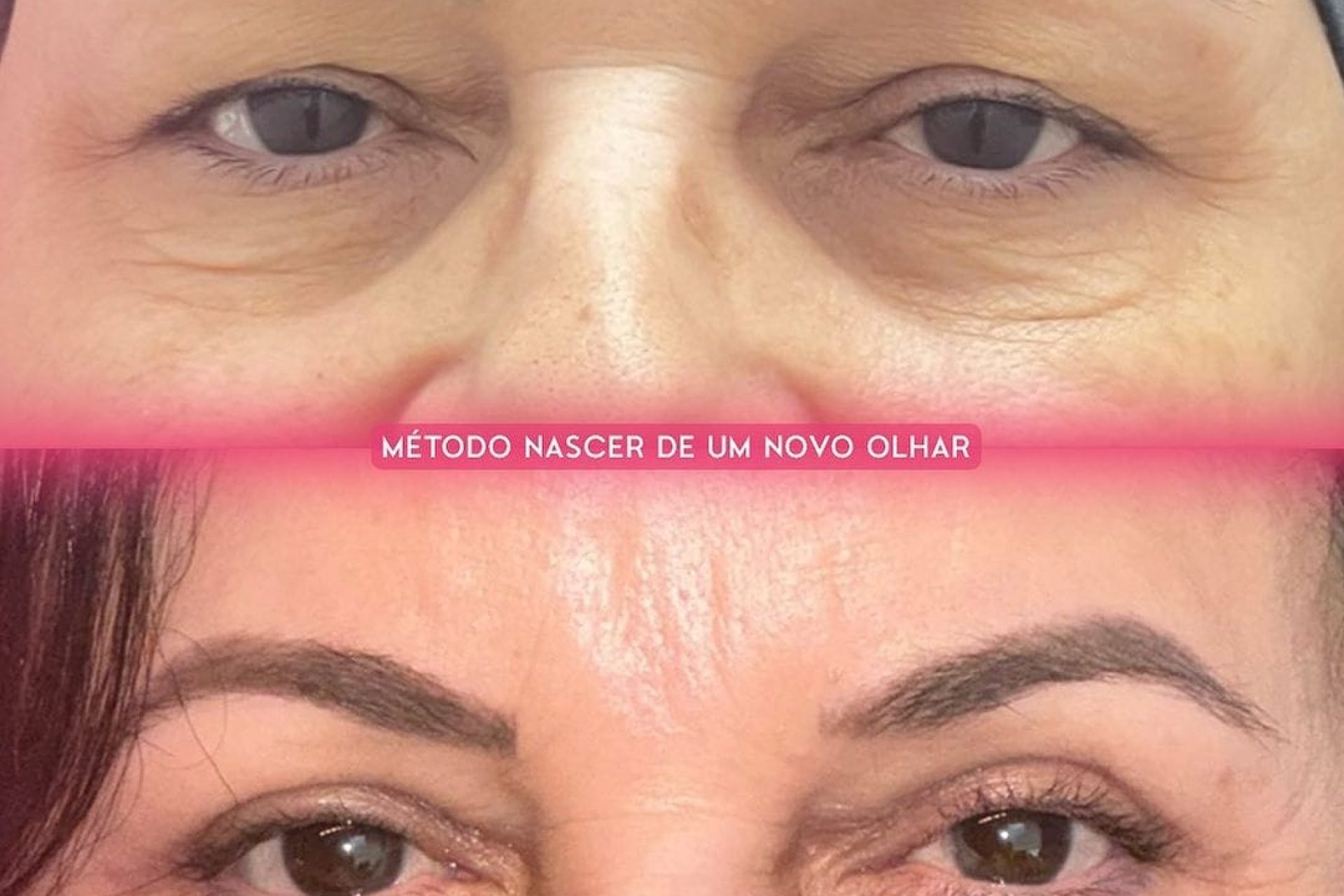 Cirurgia de blefaroplastia