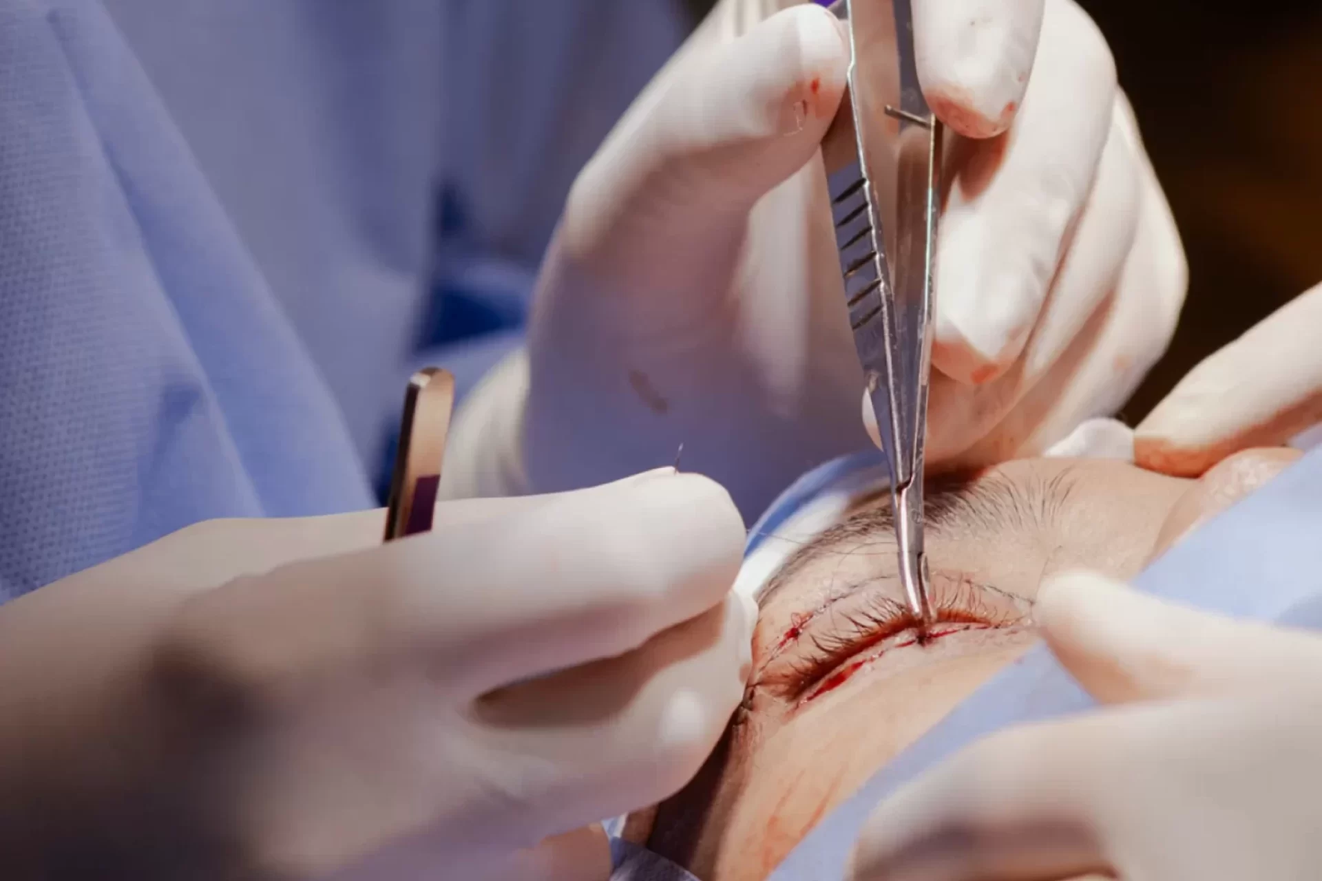 blefaroplastia após 7 dias