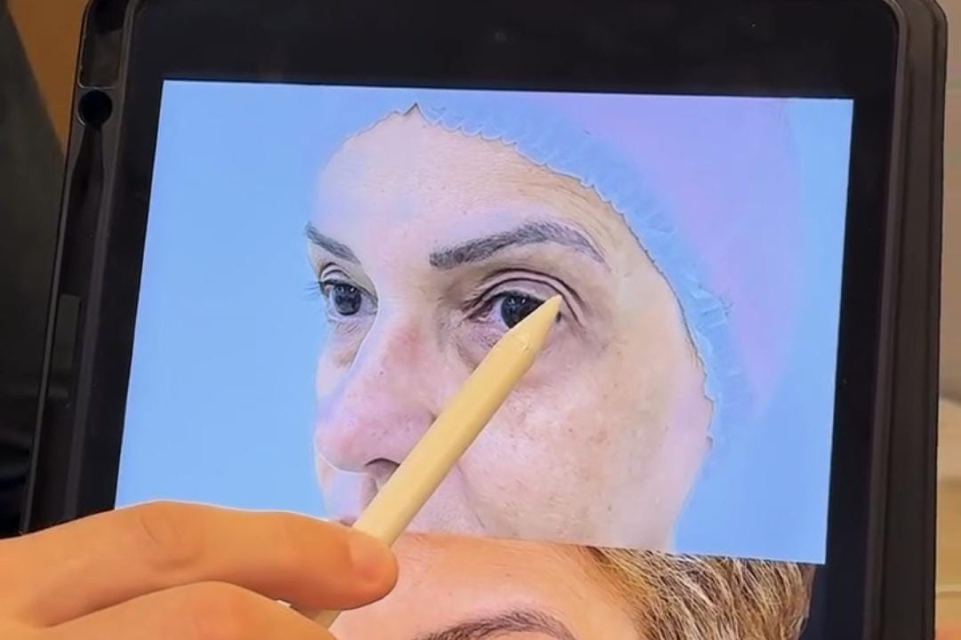 Dr. Pedro Ruiz analisa blefaroplastia