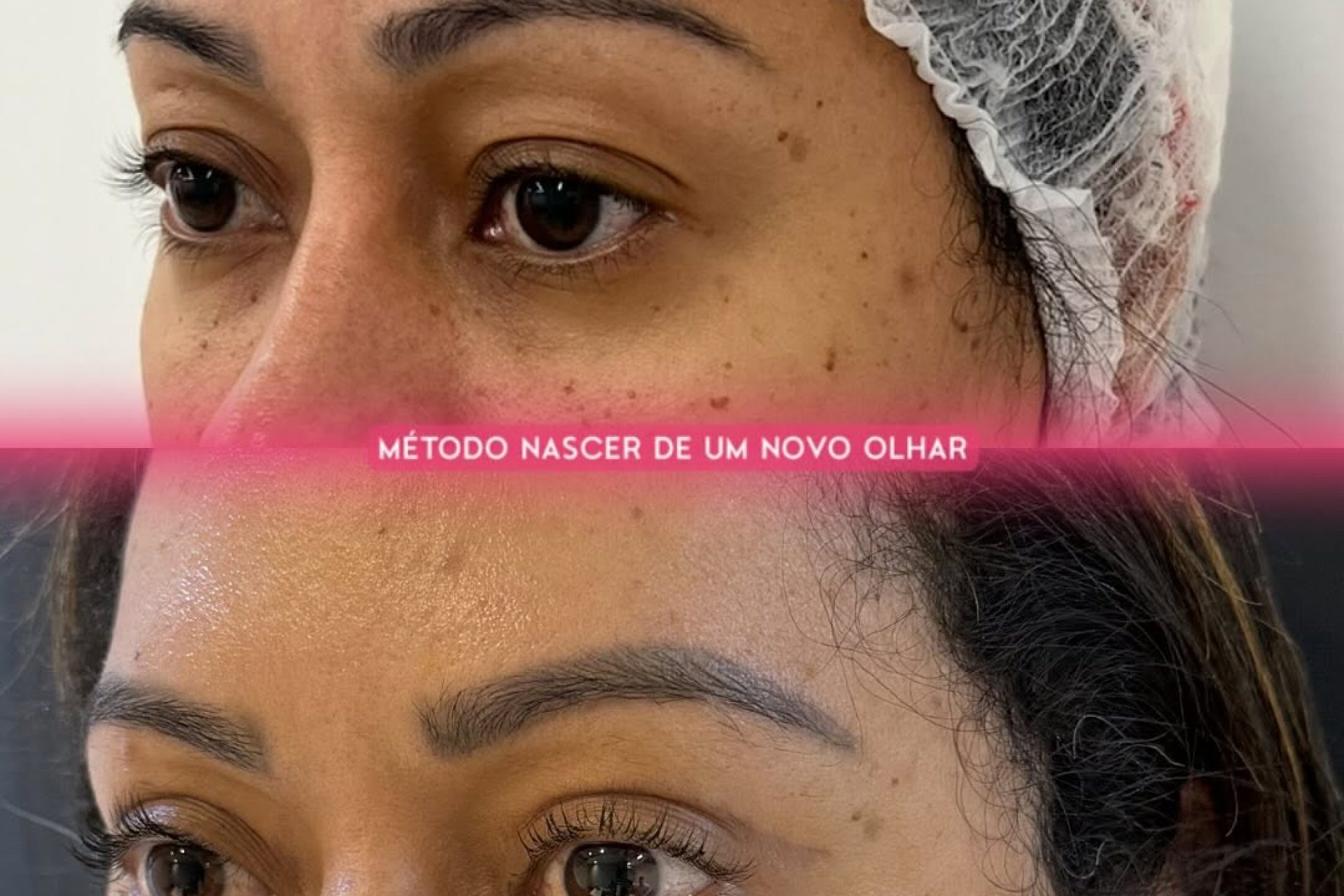 Fotos após cirurgia de pálpebras