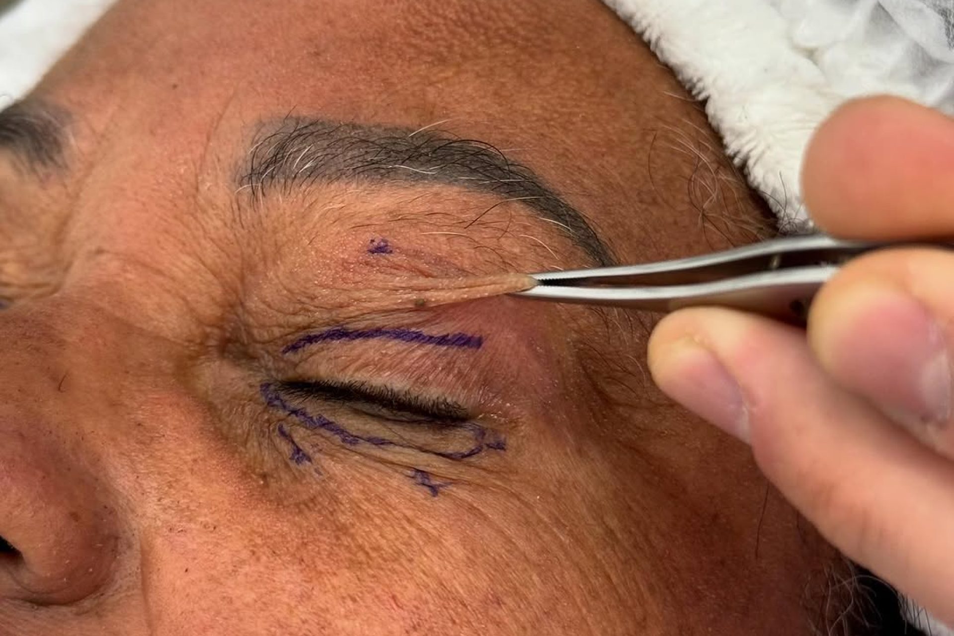 Hematomas após a blefaroplastia