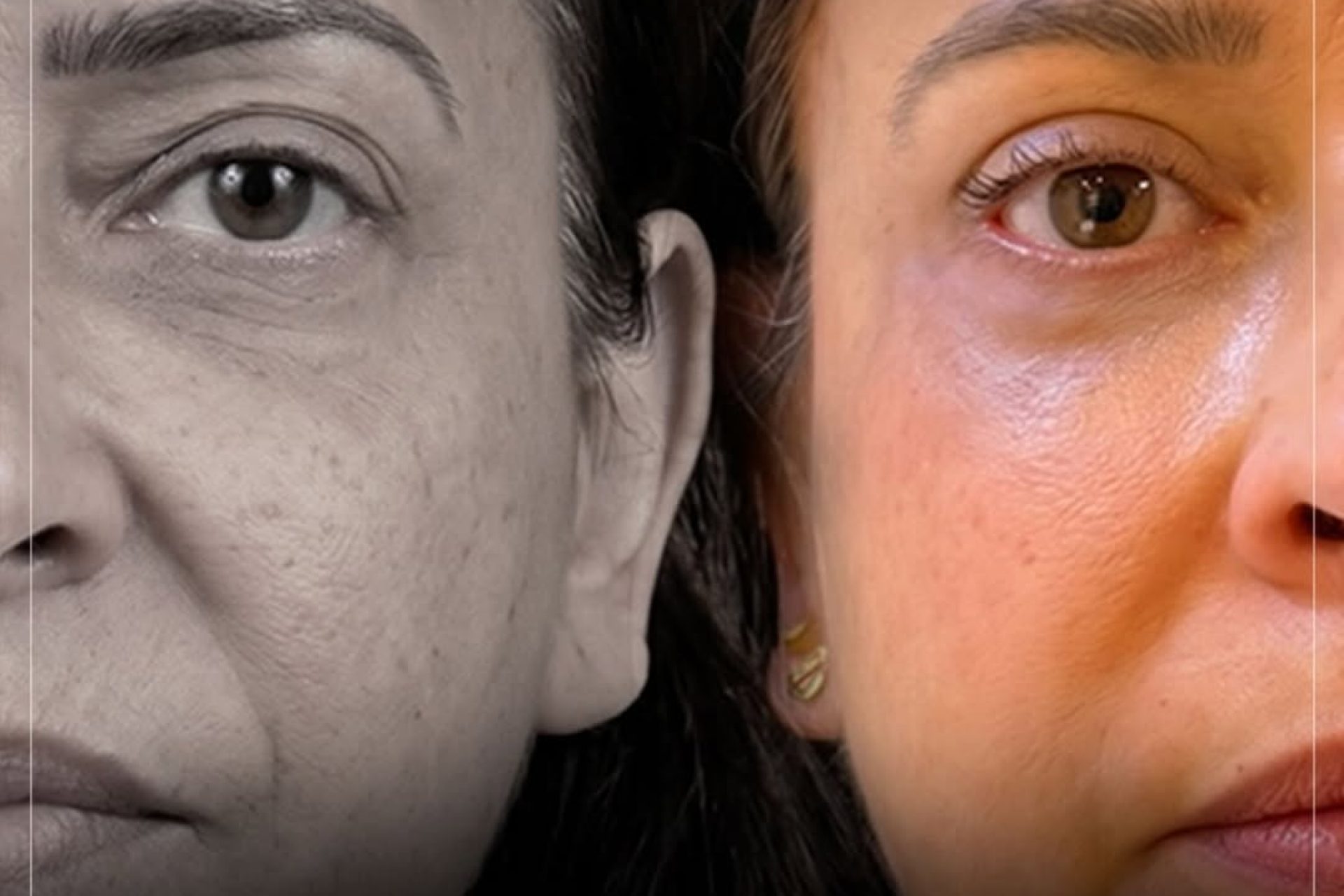 IPR BLEFAROPLASTIA CIRURGOIA DE PÁLPEBRA