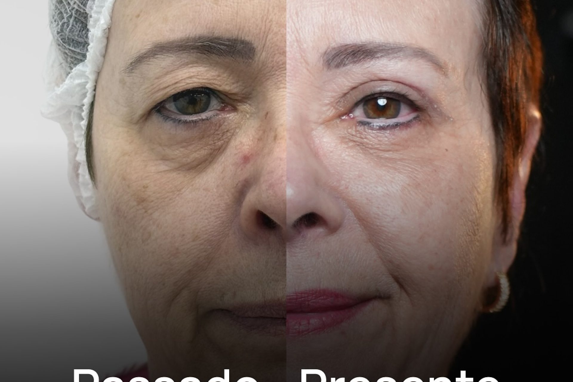 Blefaroplastia medo da cirurgia