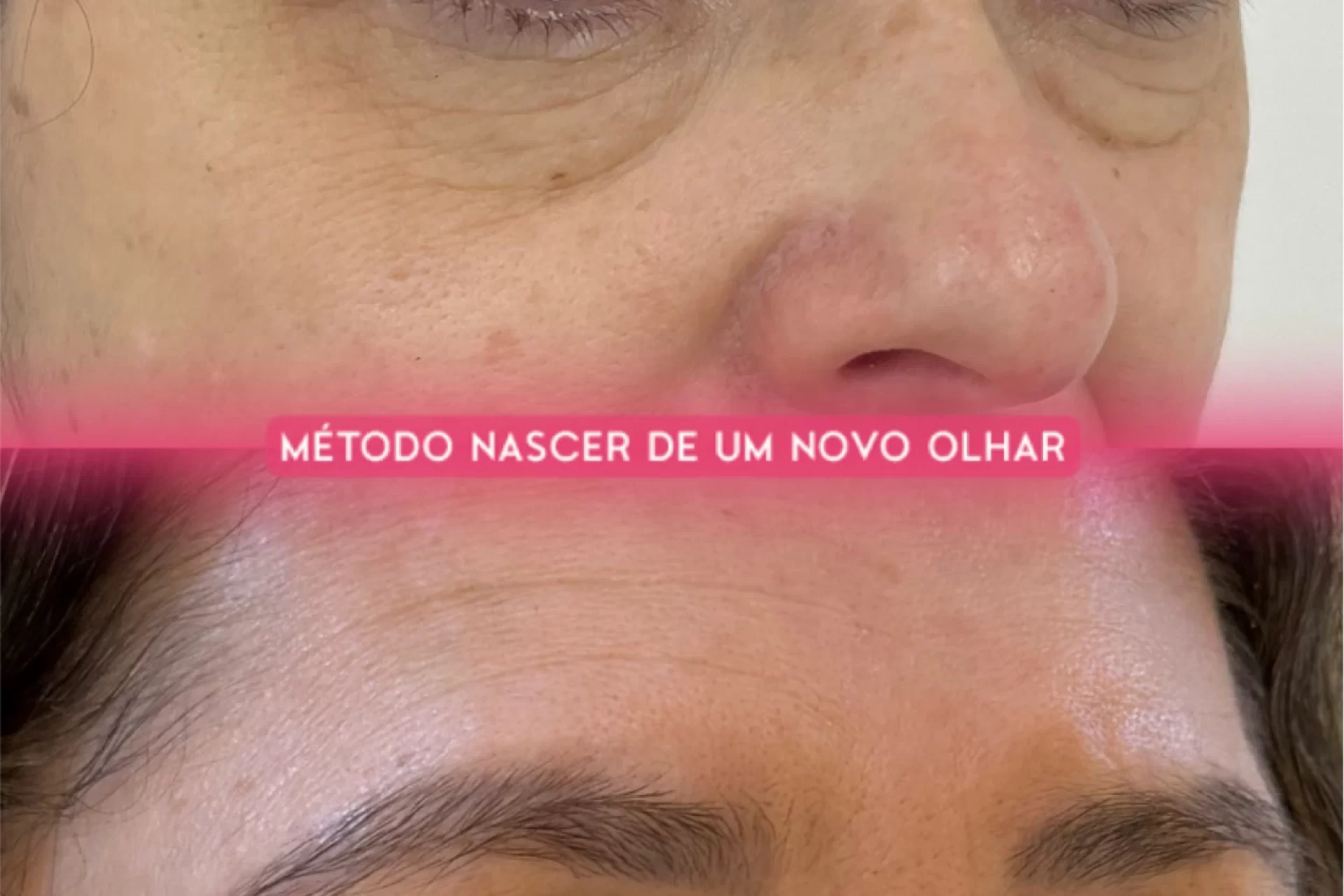 O nascer de um novo olhar_blefaroplastia