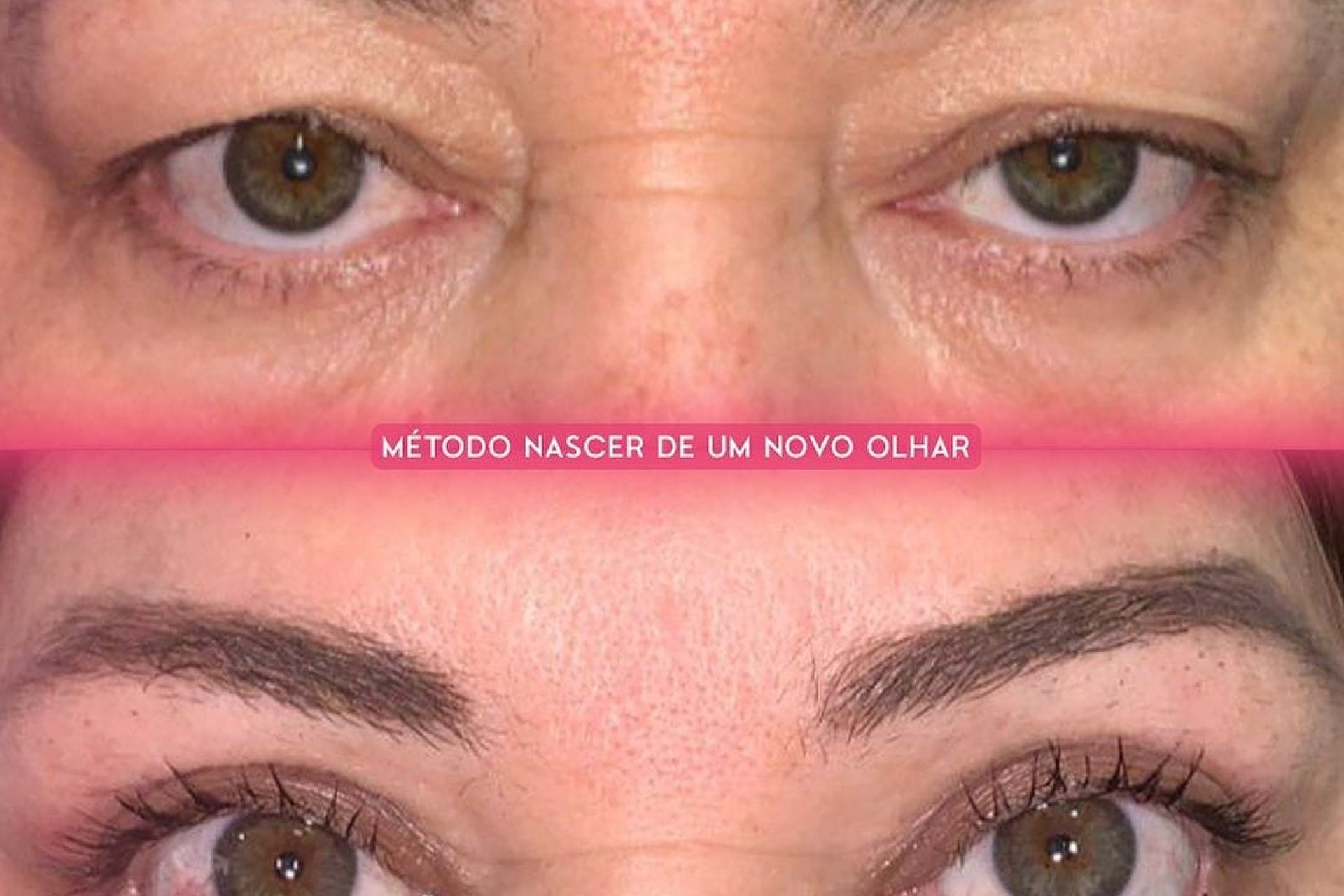 pós-operatório de blefaroplastia
