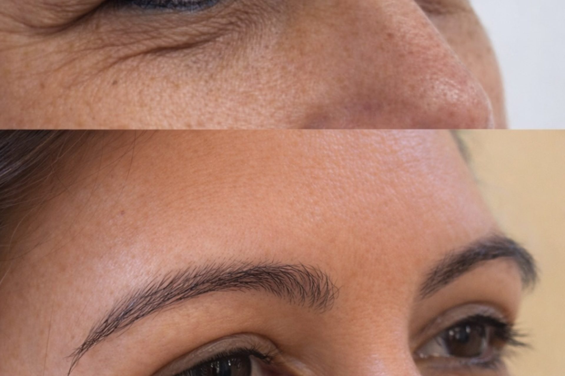 Pós operatório da blefaroplastia