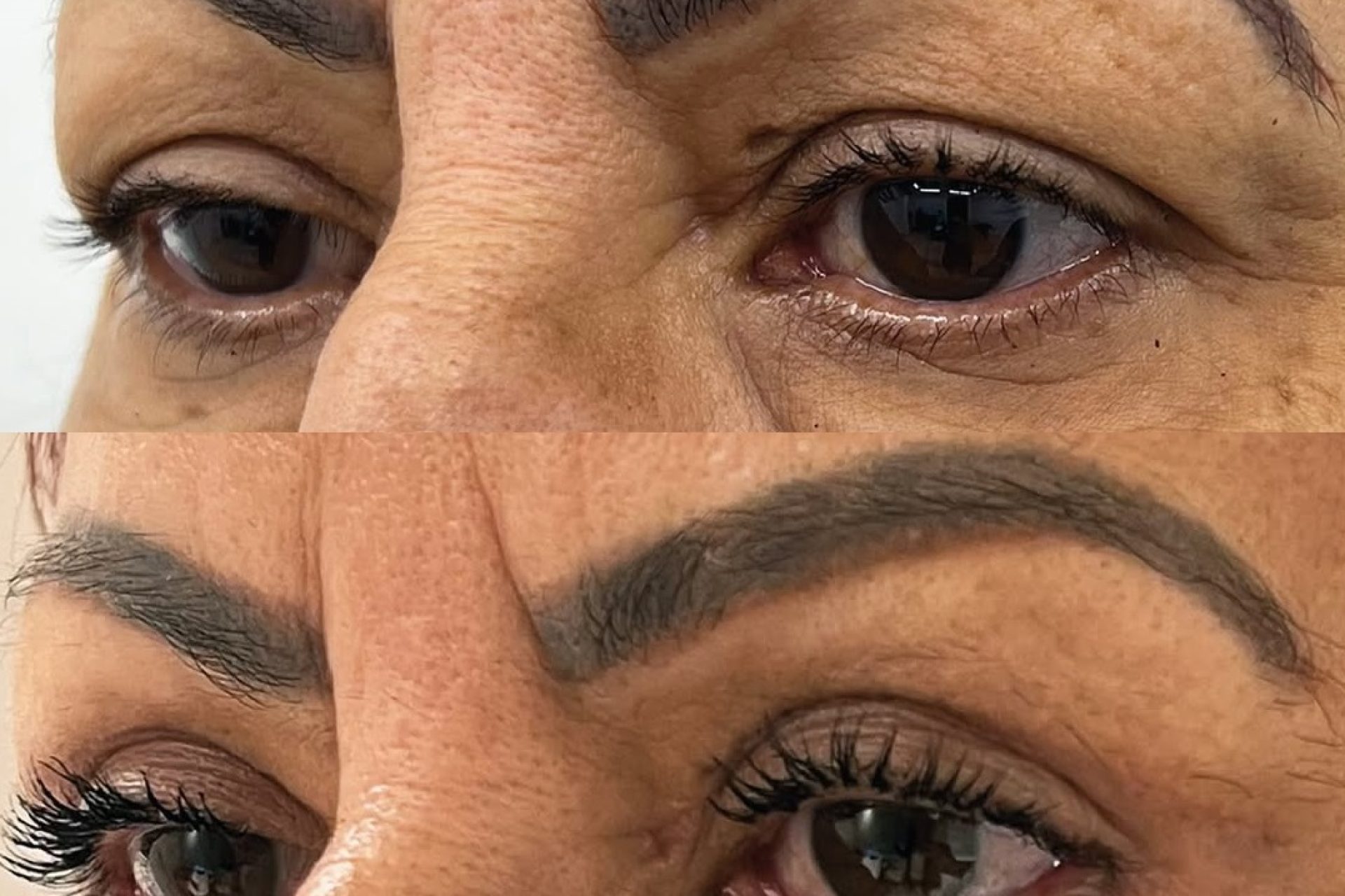 Quando a blefaroplastia passa a ser funcional