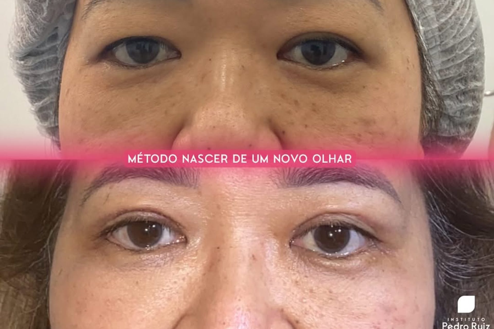 Blefaroplastia Antes e depois
