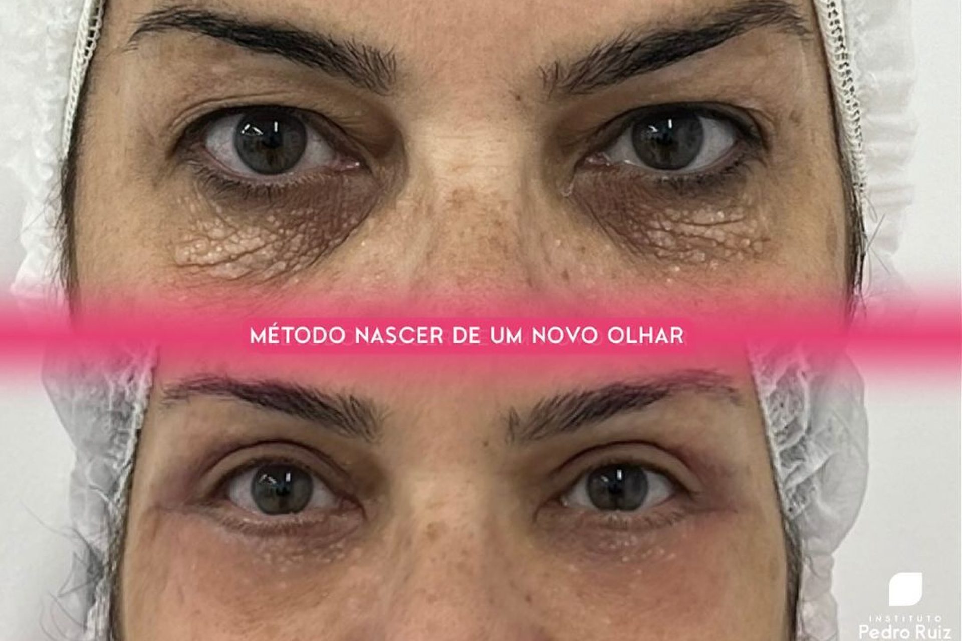 Blefaroplastia_nascer de um novo olhar_resultado
