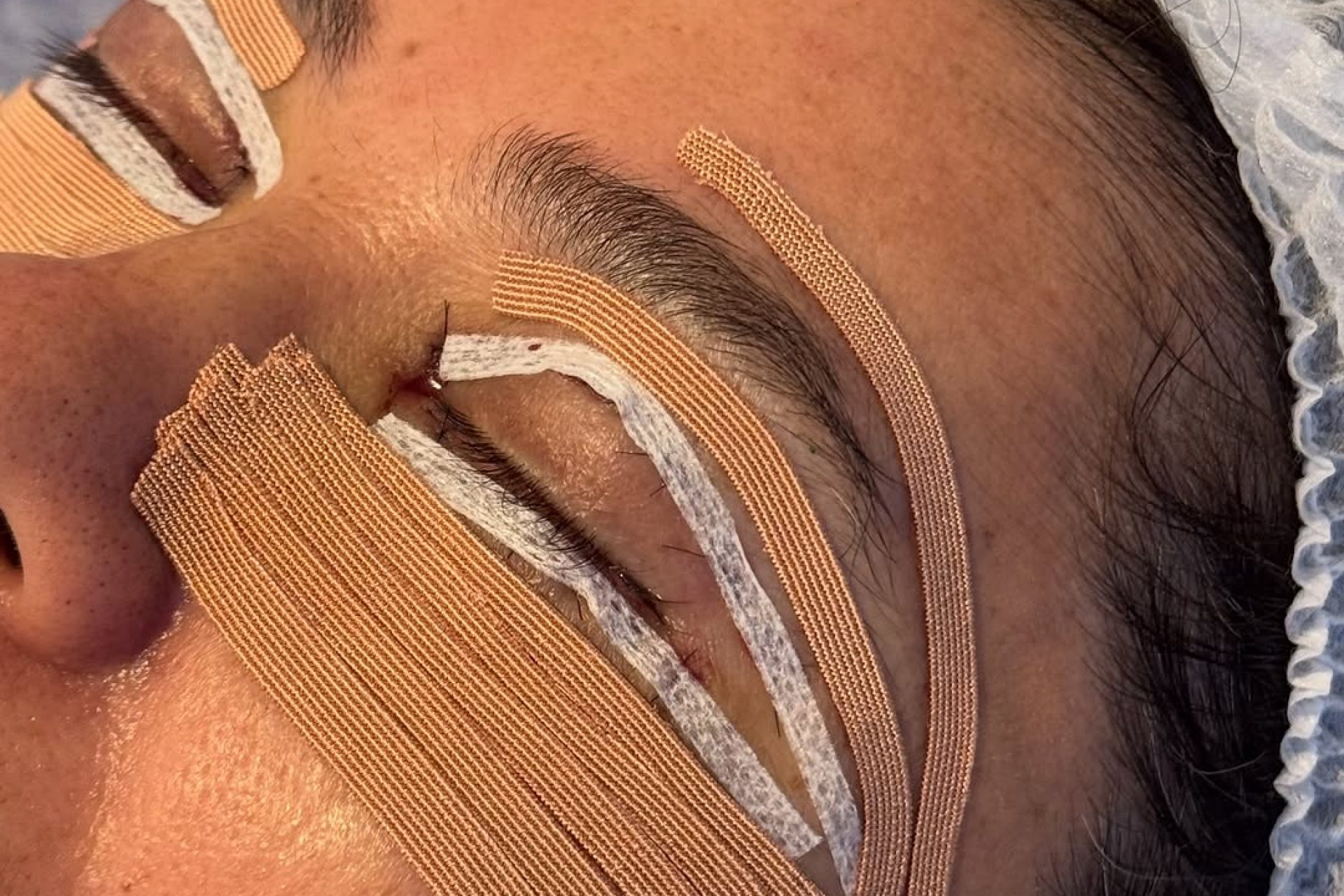 Taping pós-operatório blefaroplastia