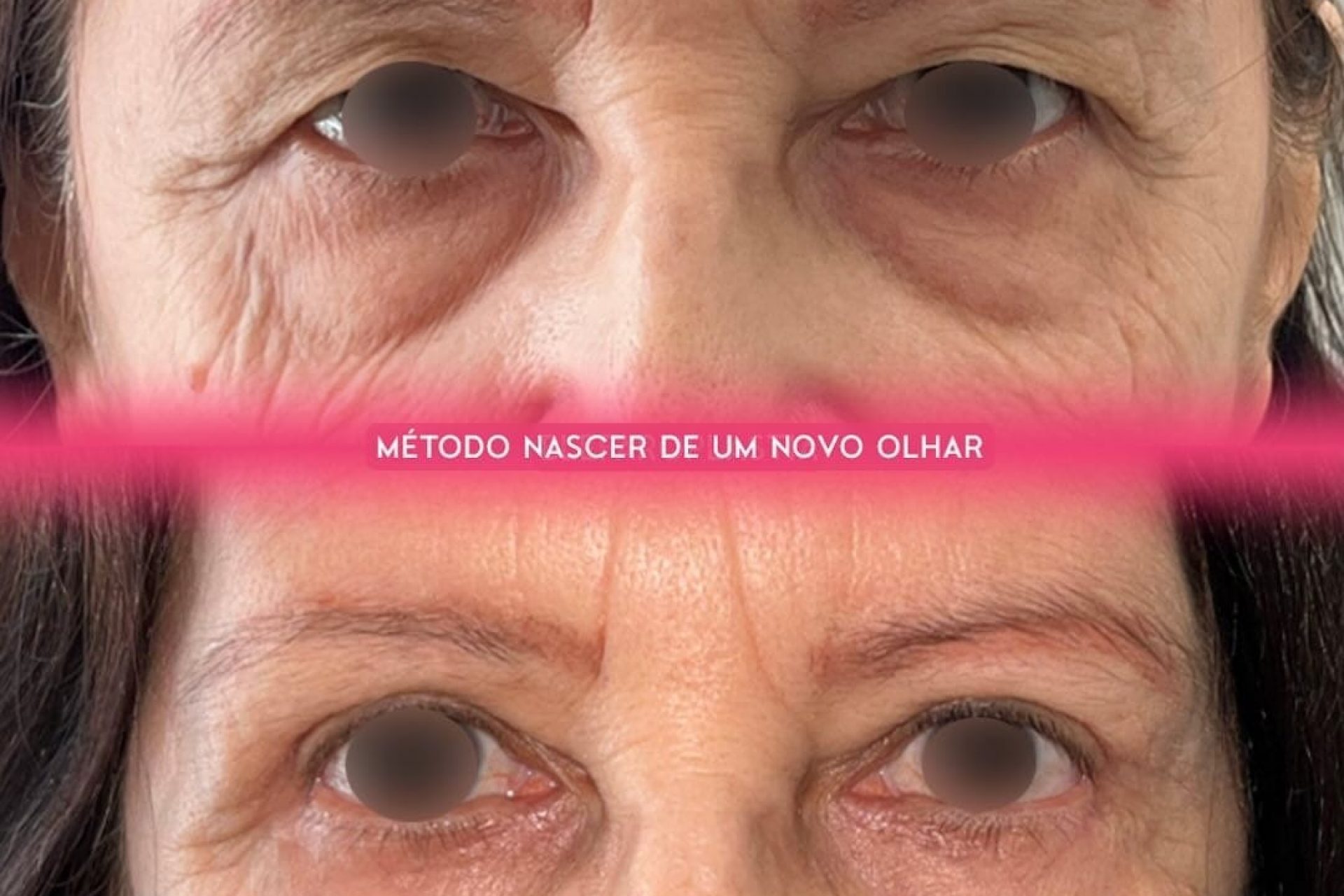 Tipos de blefaroplastia