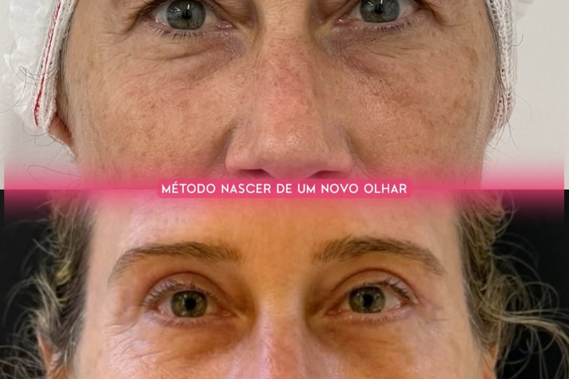 blefaroplastia 40 anos 60 anos