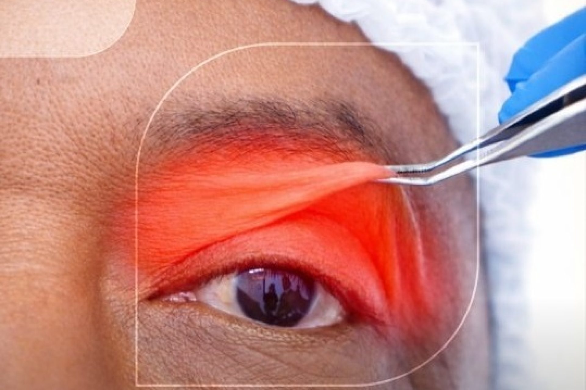 blefaroplastia-altera-expressao-rosto
