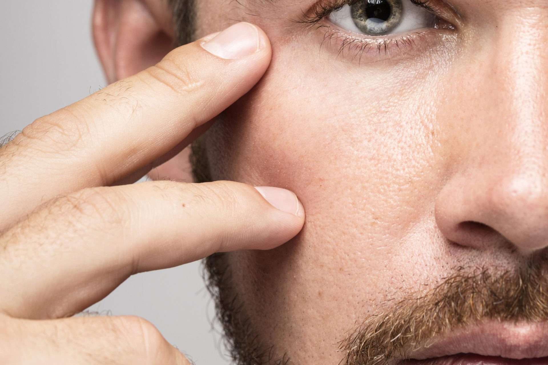 blefaroplastia antes e depois em homens